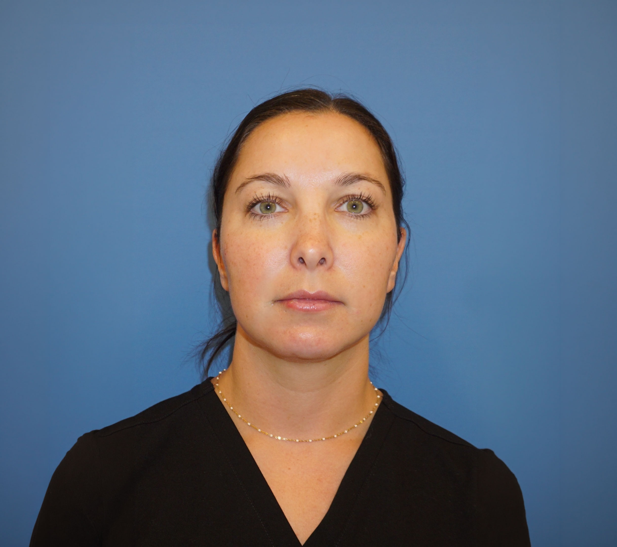Instalift – Patient 2 After