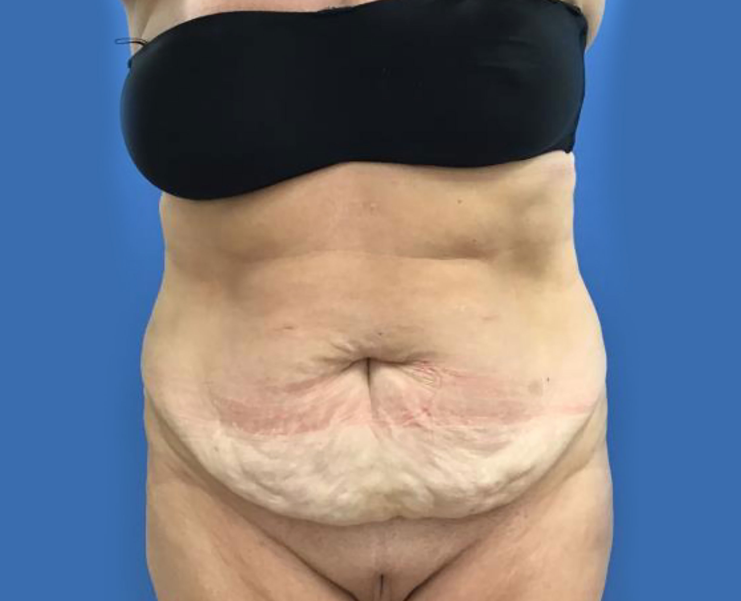Tummy Tuck - Patient 2 Before