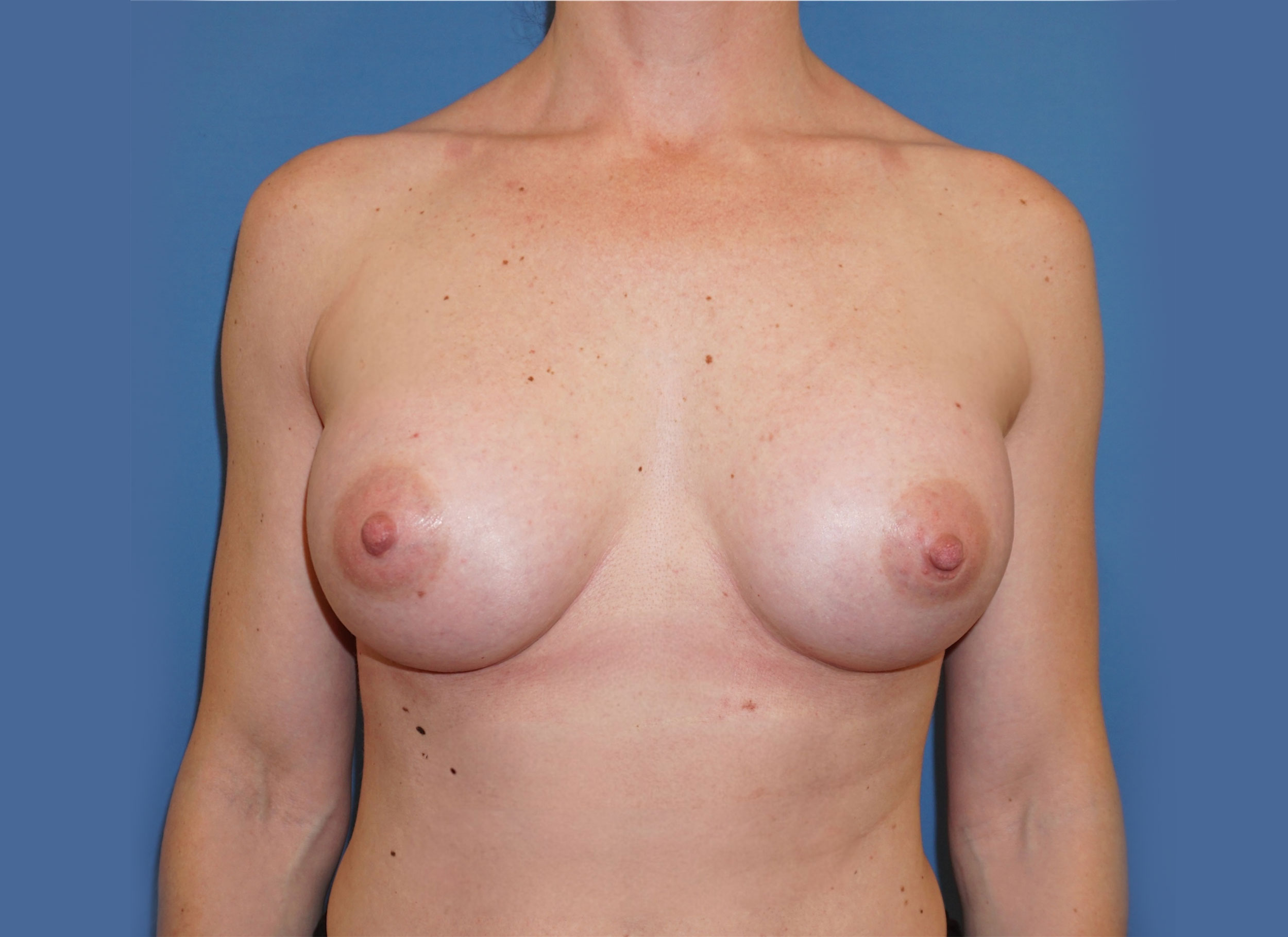Breast Augmentation – Patient 2 After
