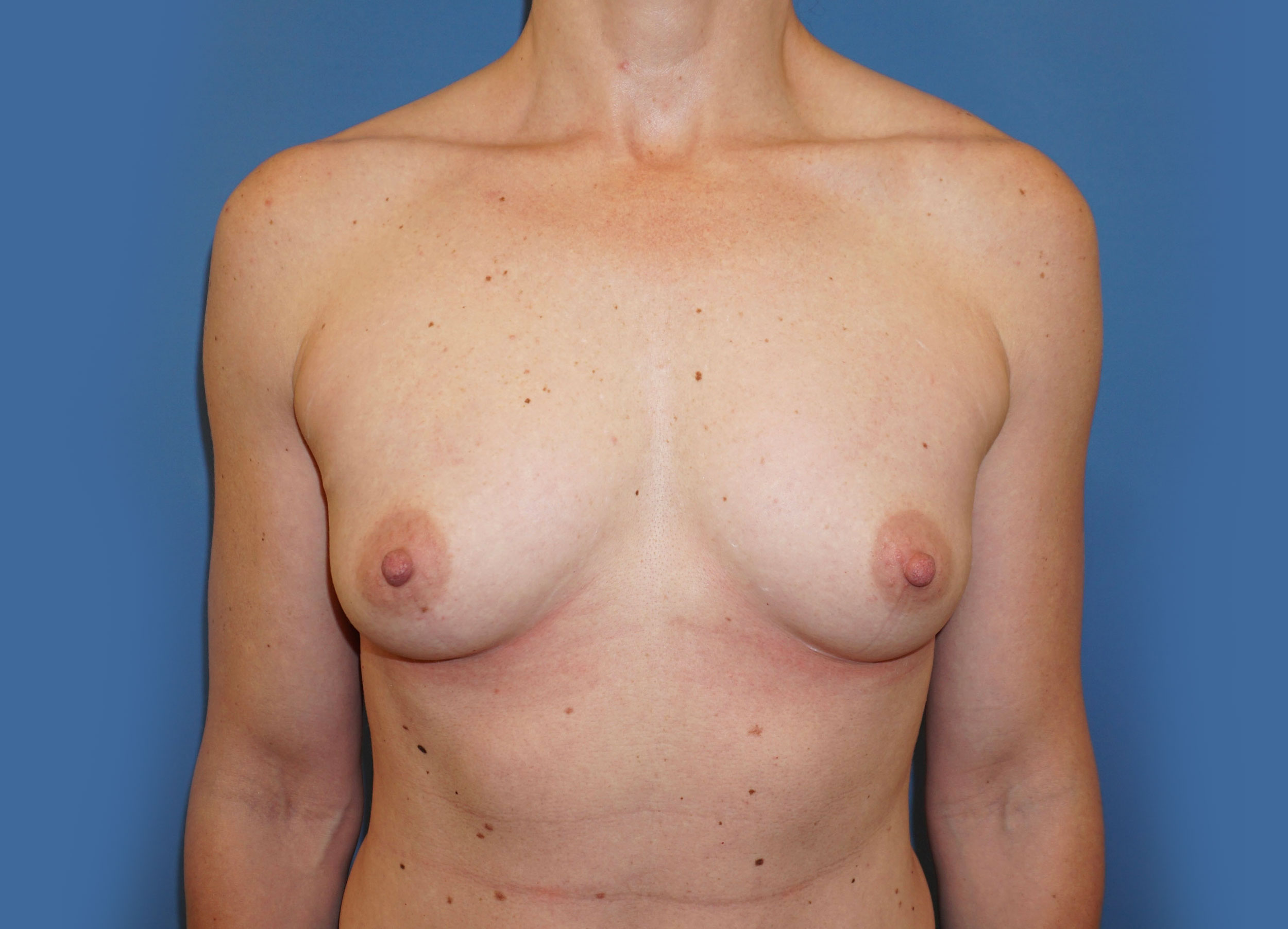 Breast Augmentation – Patient 2 Before
