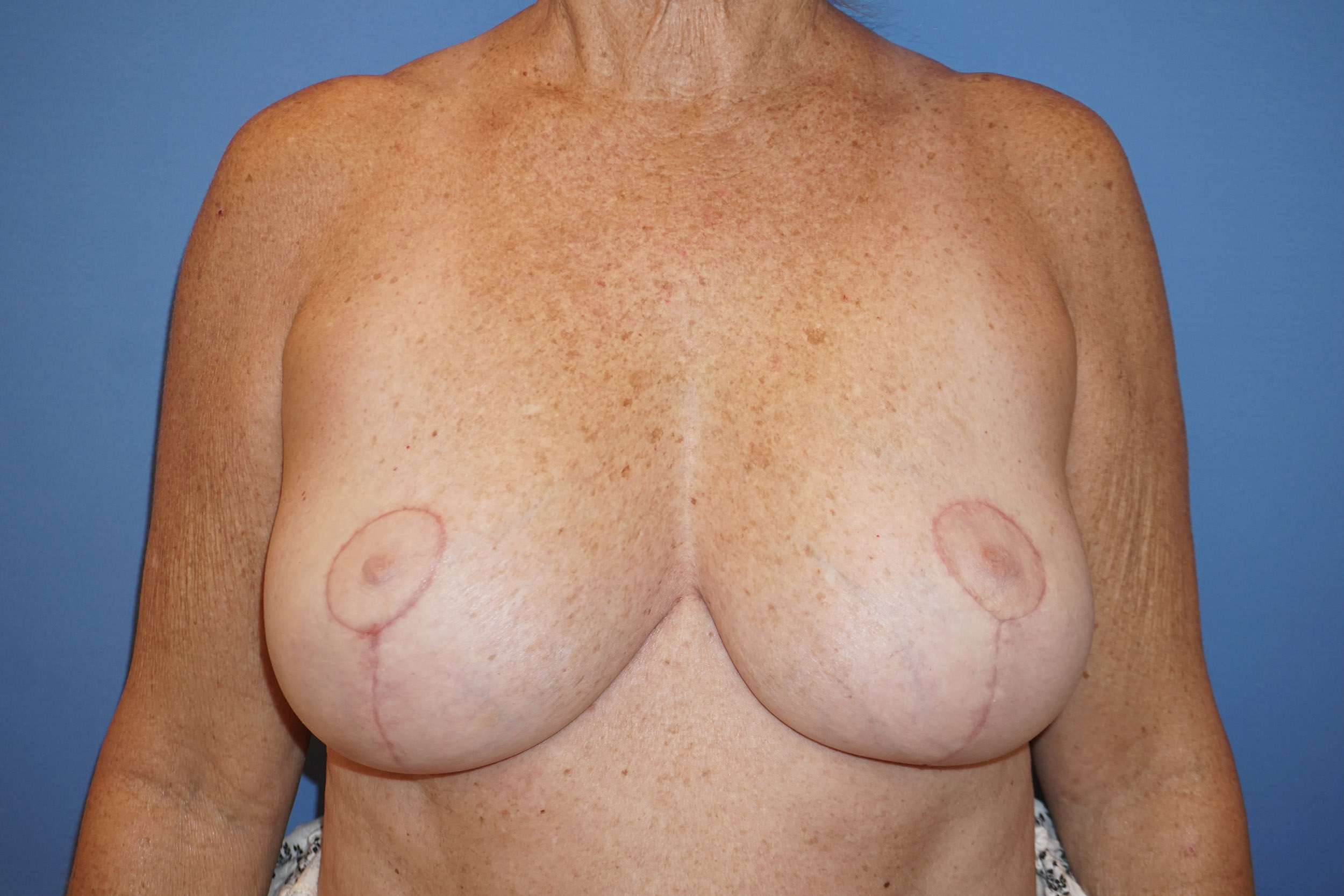 Breast Lift – Patient 20 After