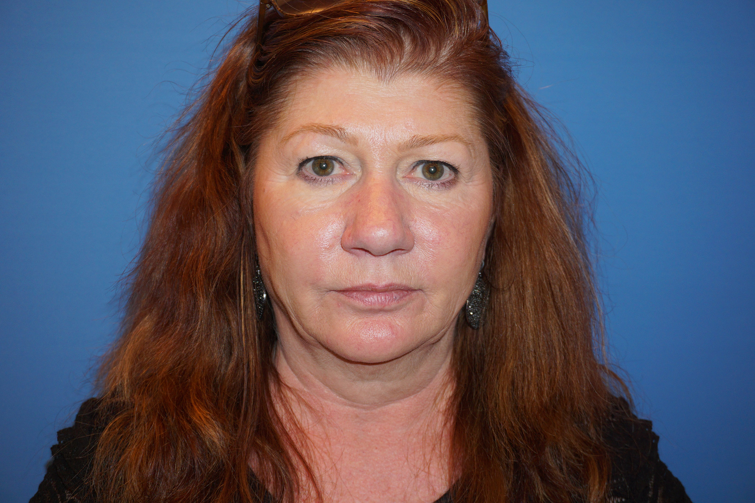 Blepharoplasty – Patient 3 Before