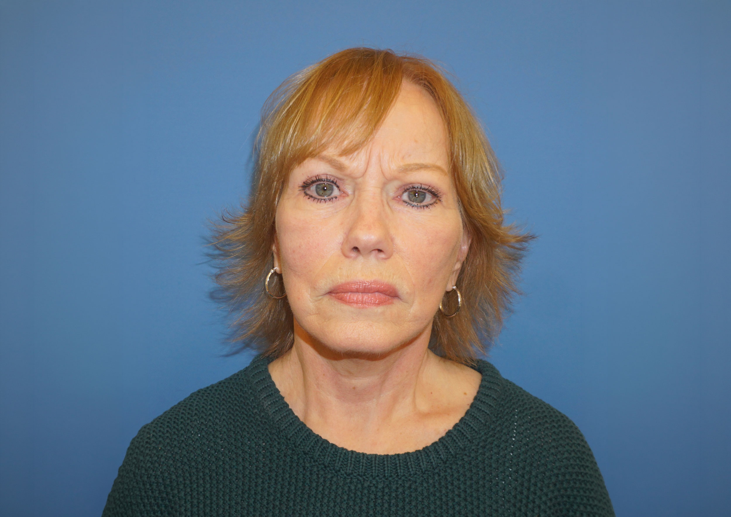 Facelift Patient 4 After