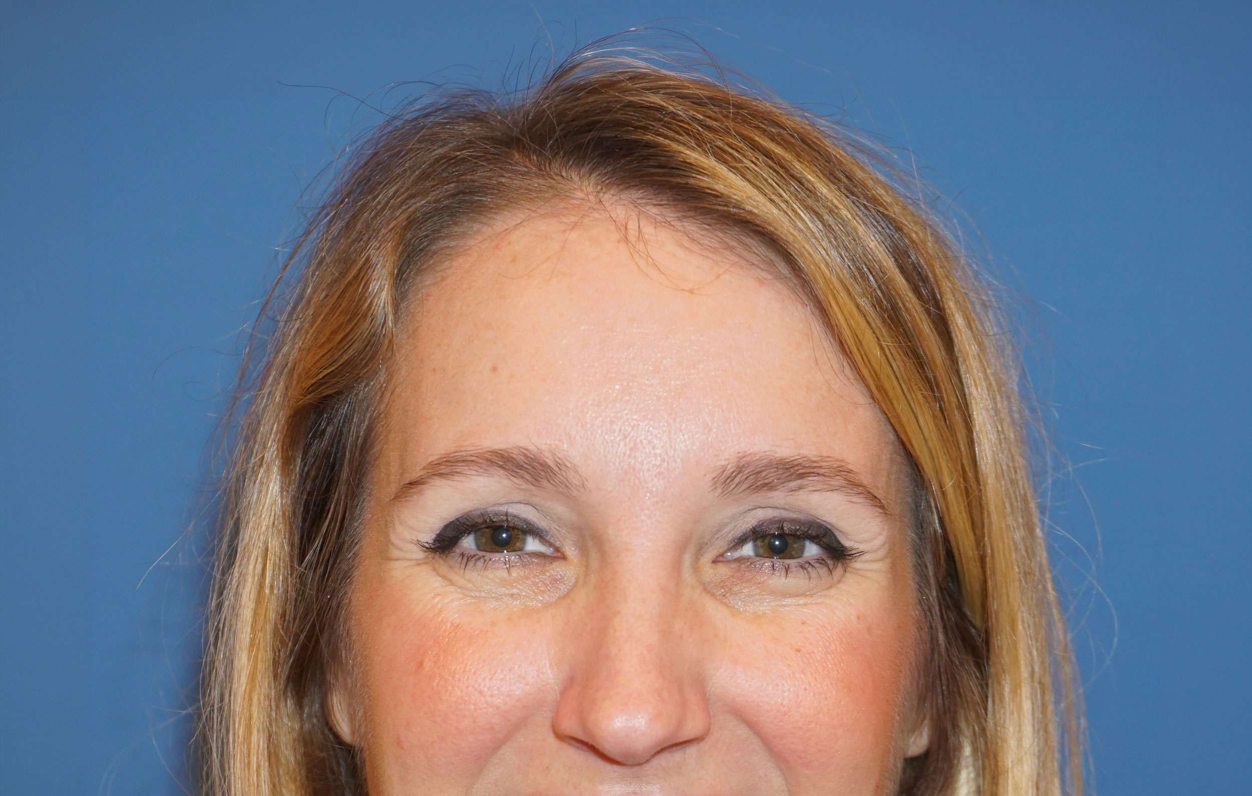 Botox – Patient 4 After