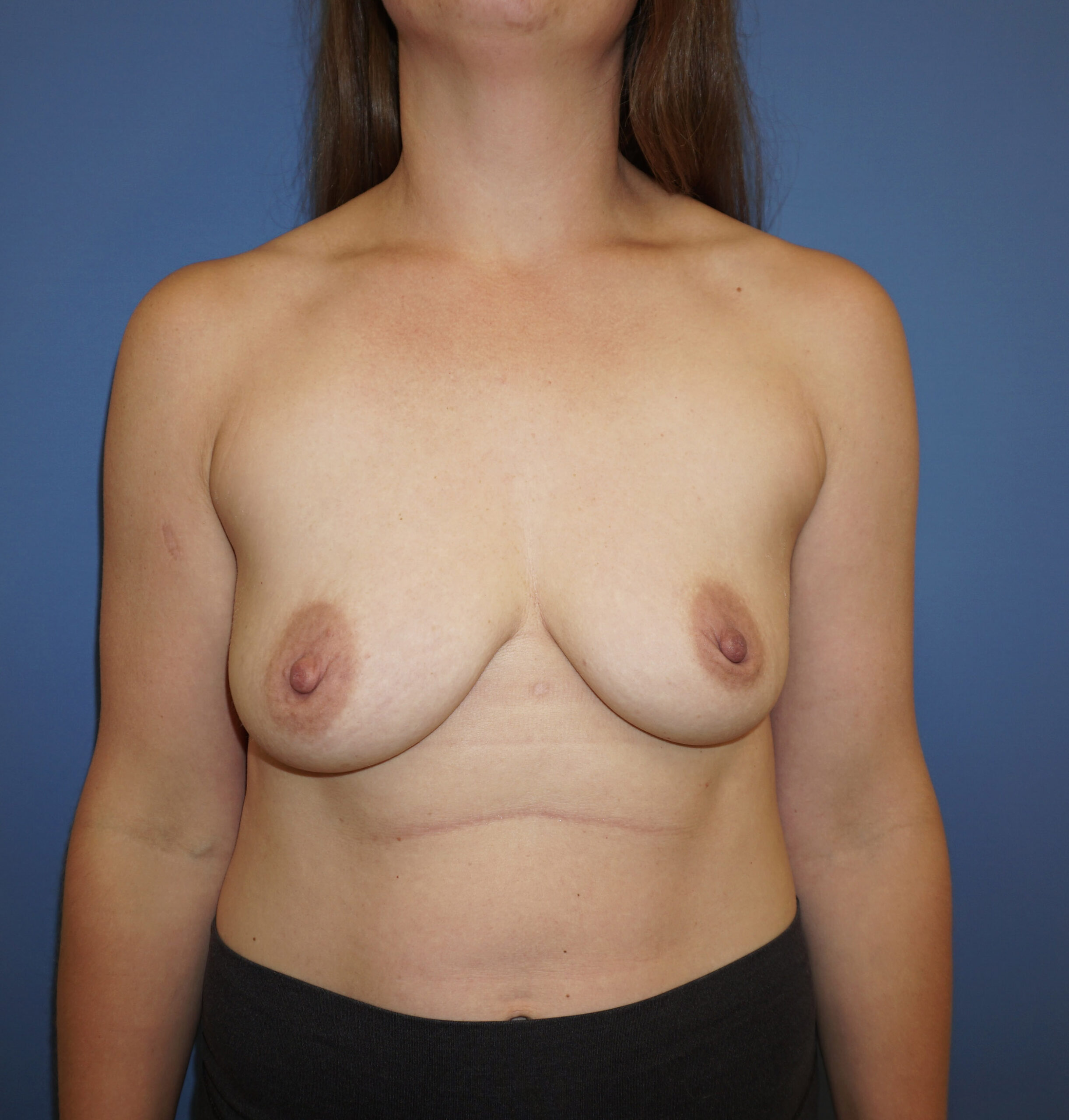 Breast Lift with Implant – Patient 4 Before