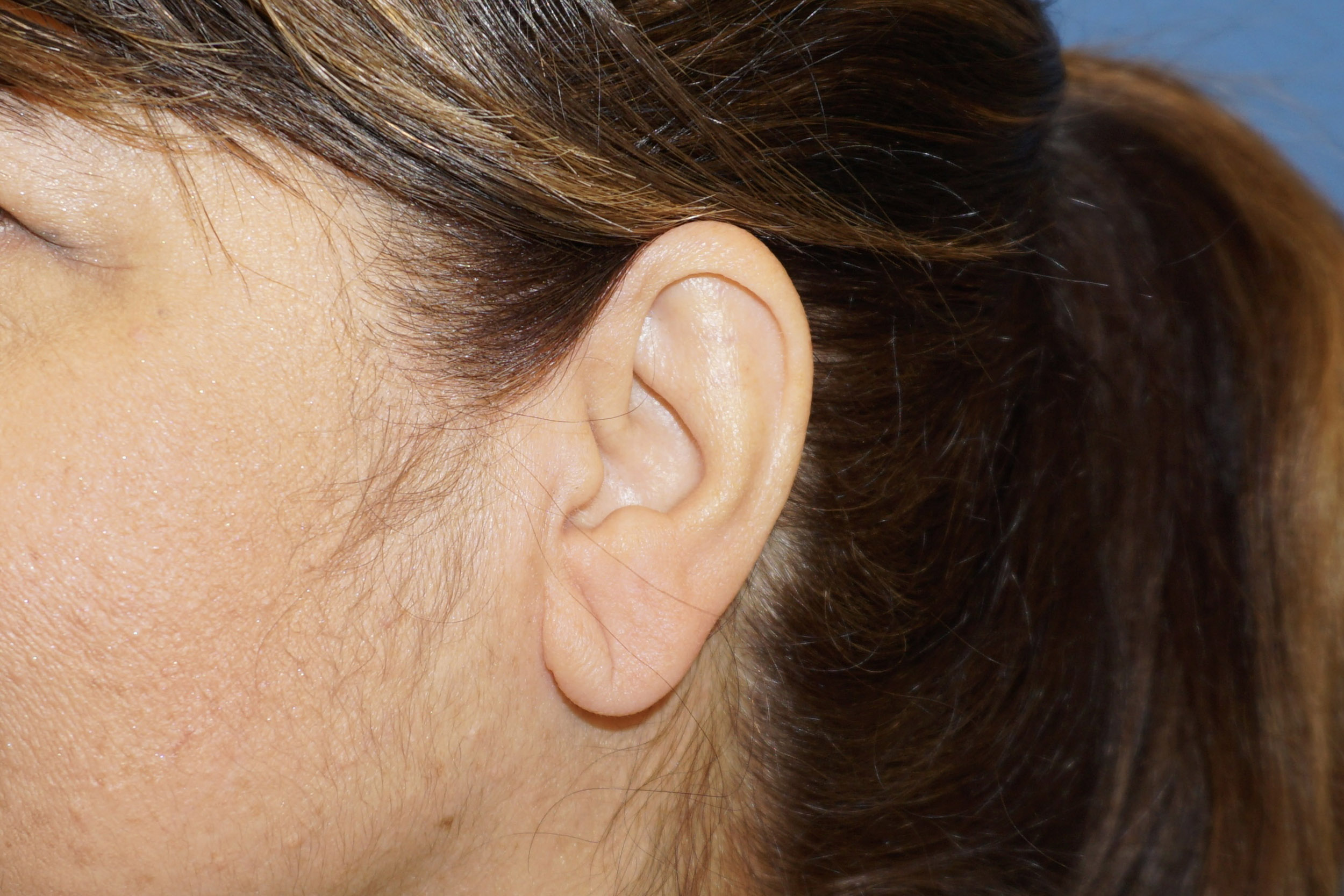 Ear Surgery – Patient 4 Before