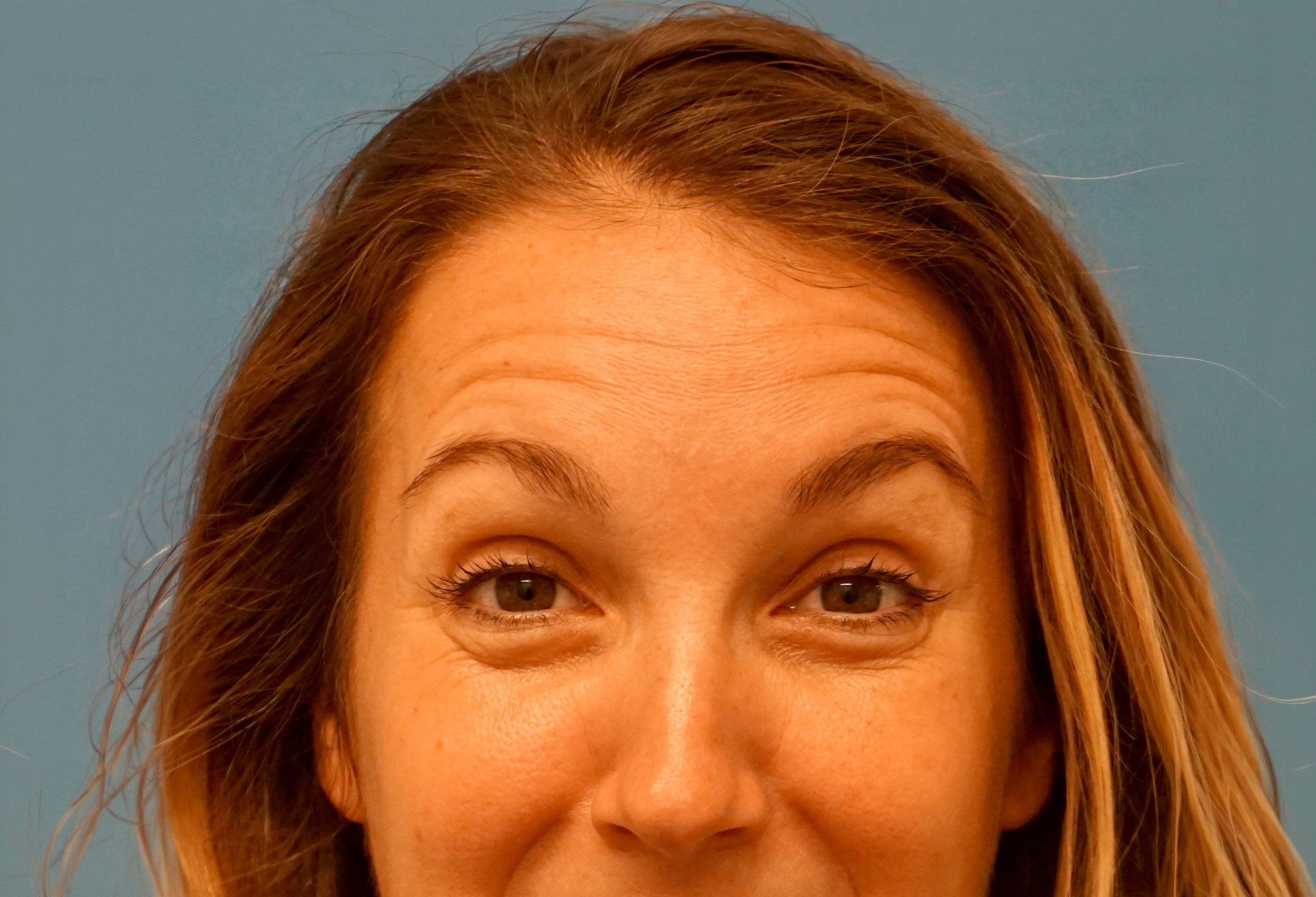 Botox – Patient 4 Before