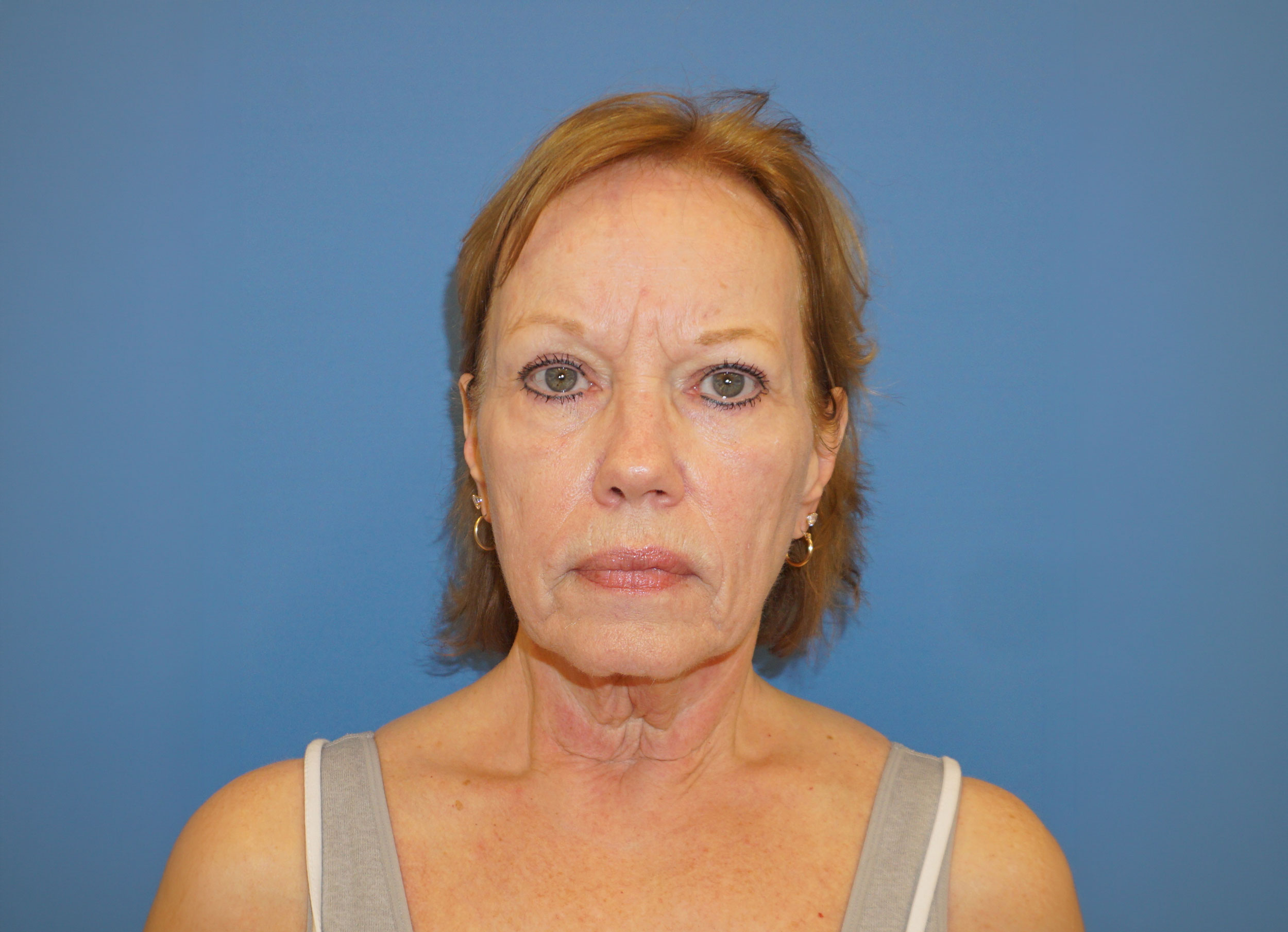 Facelift Patient 4 Before