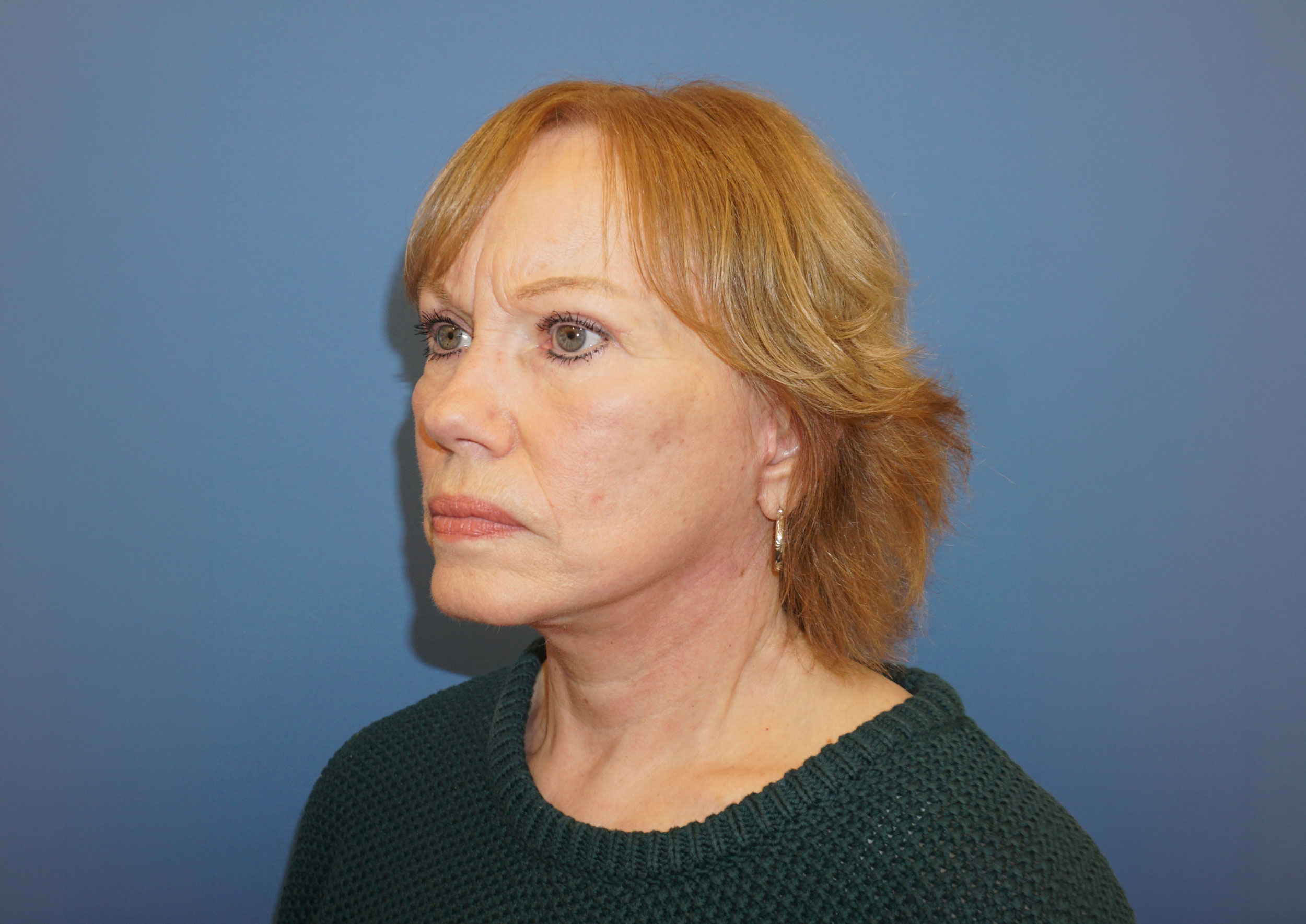 Facelift Patient 4 After