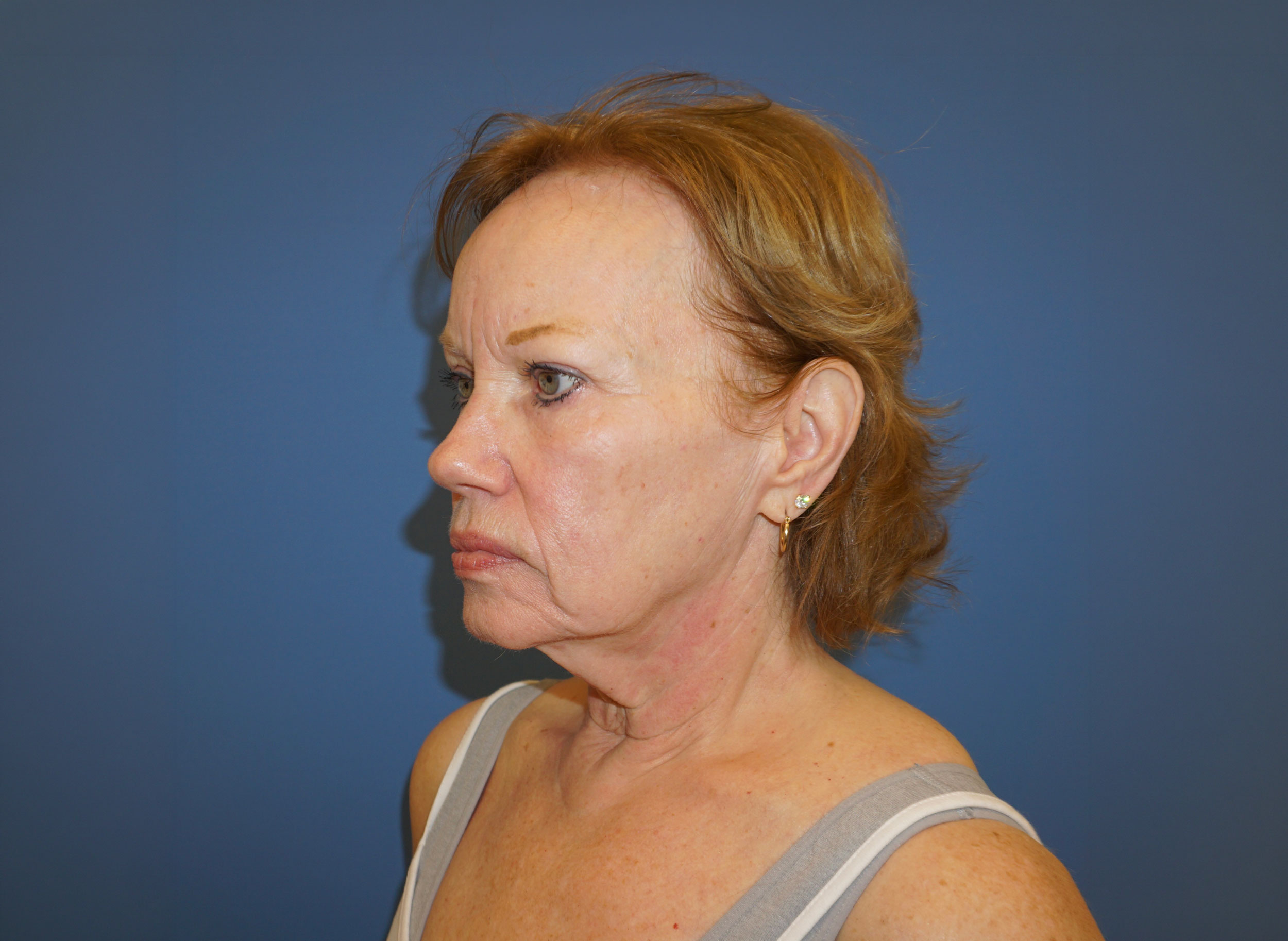 Facelift Patient 4 Before