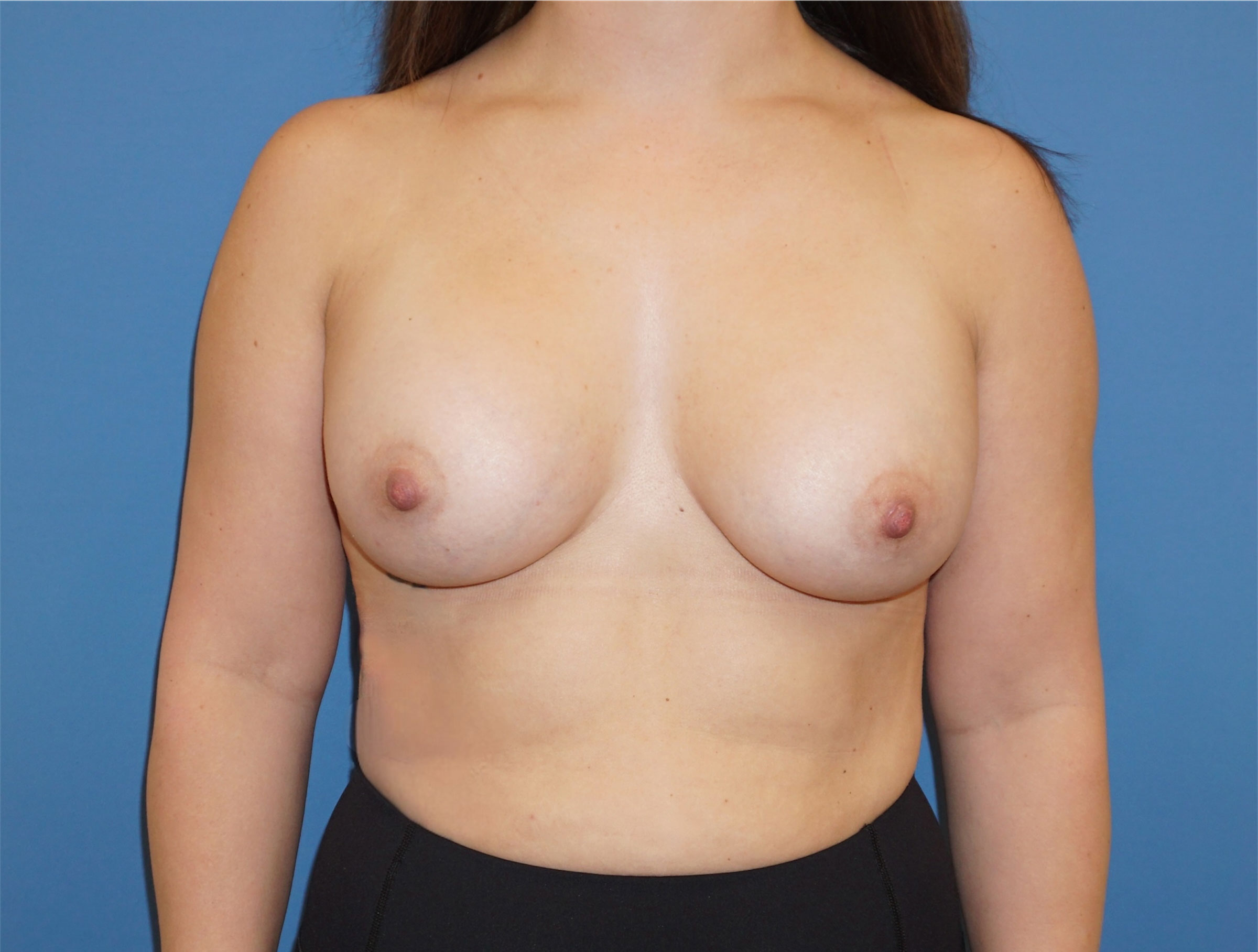 Breast Augmentation – Patient 5 After