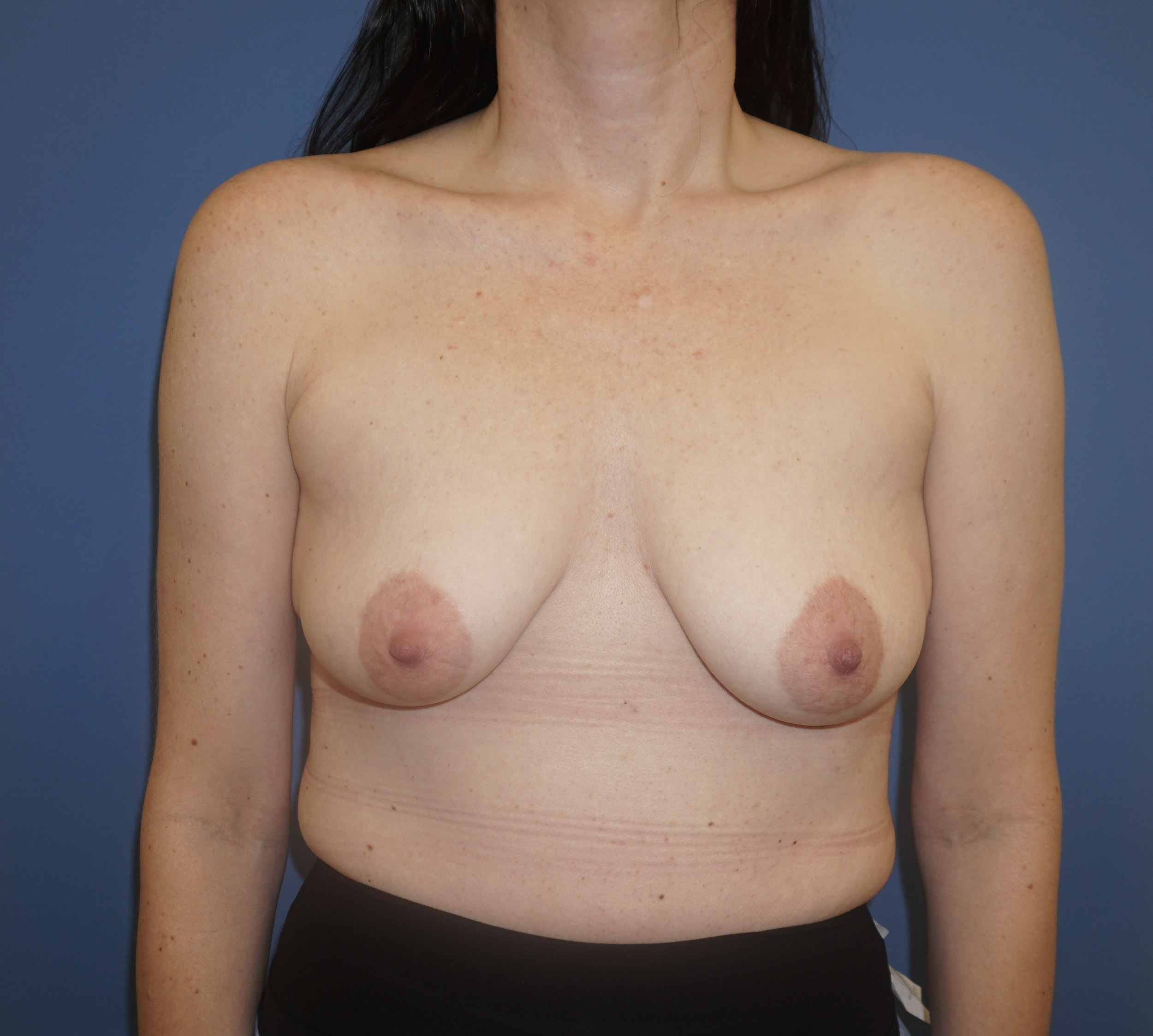 Breast Lift with Implant – Patient 5 Before