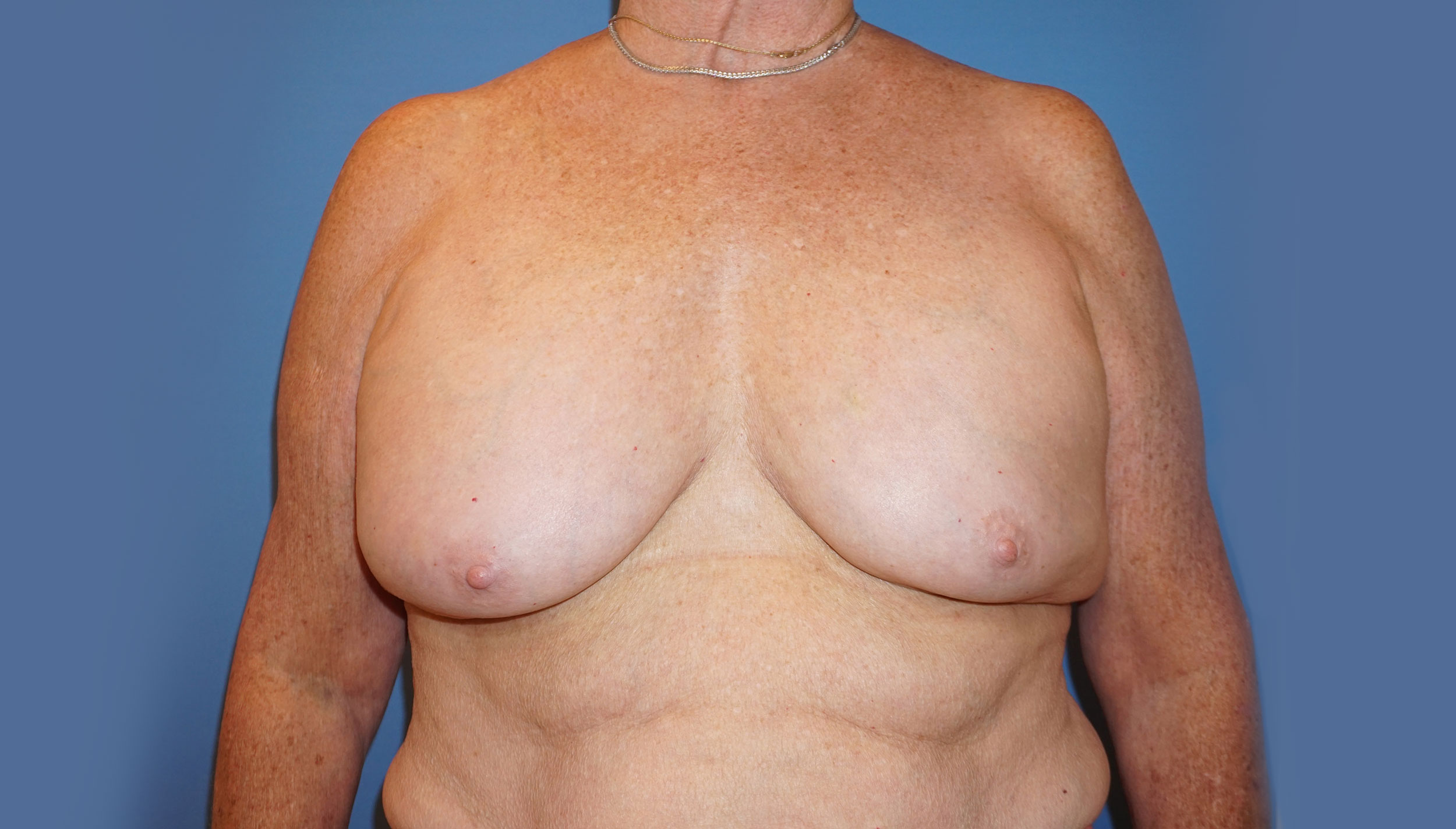 Breast Implant Exchange – Patient 5 Before