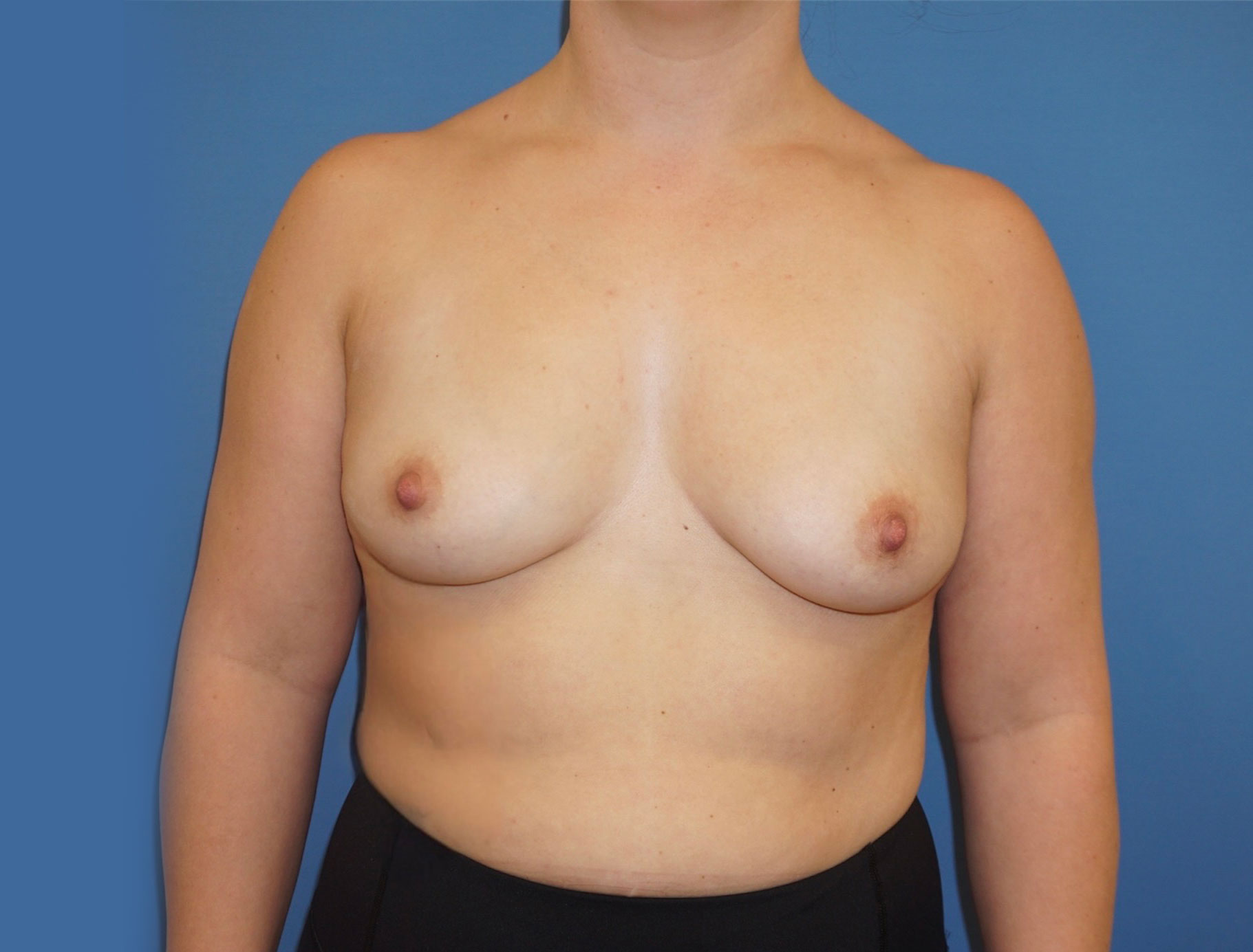 Breast Augmentation – Patient 5 Before