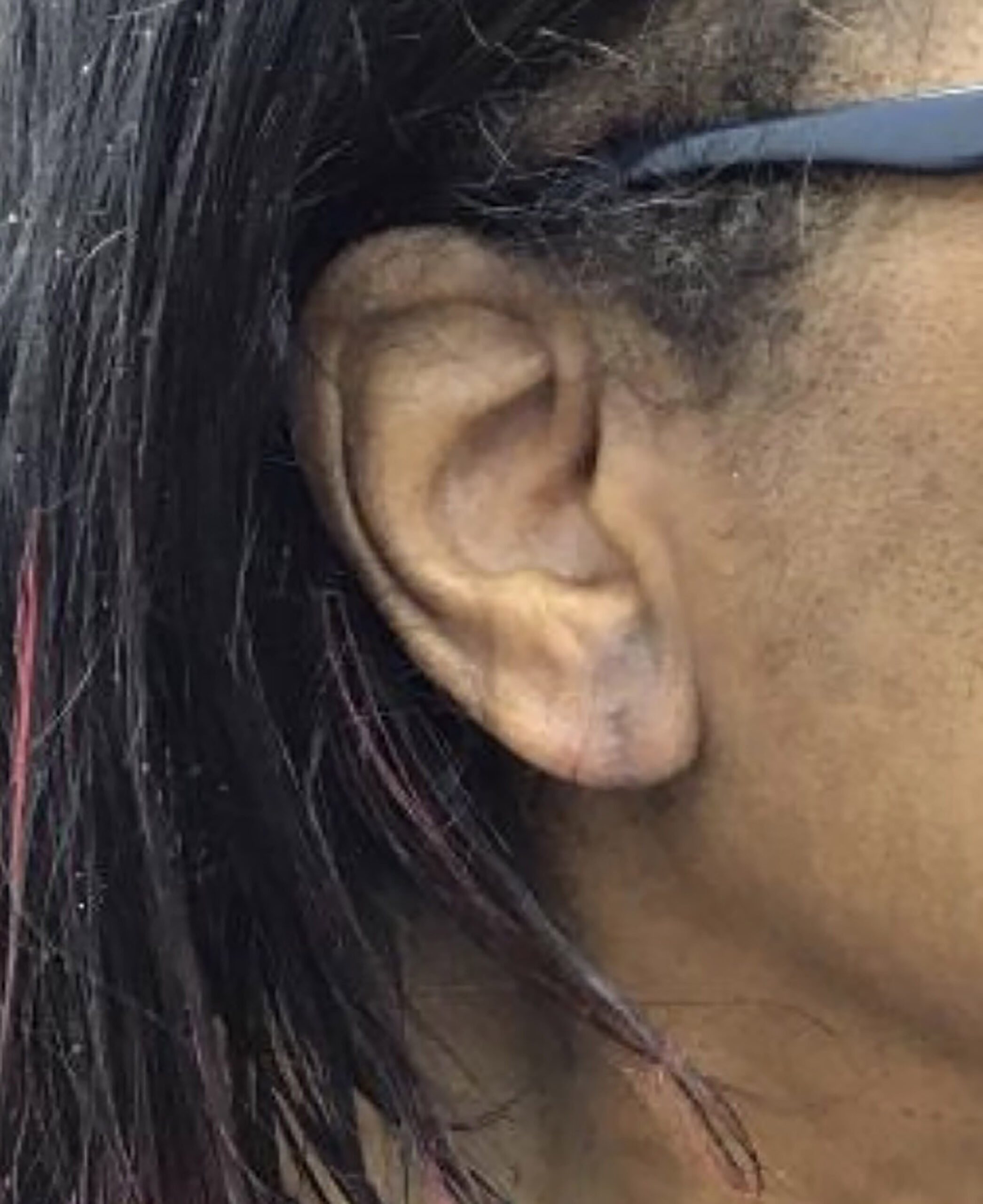 Ear Surgery – Patient 6 After