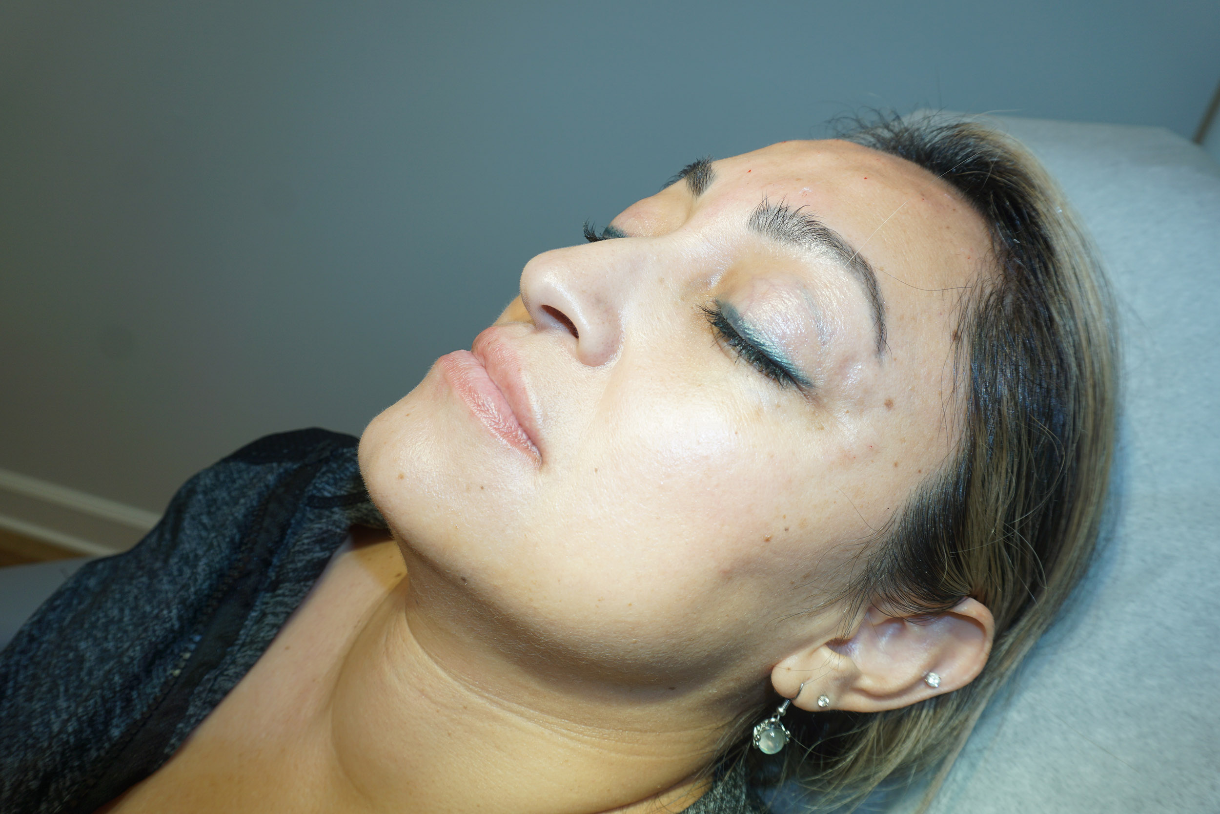 Botox – Patient 6 Before