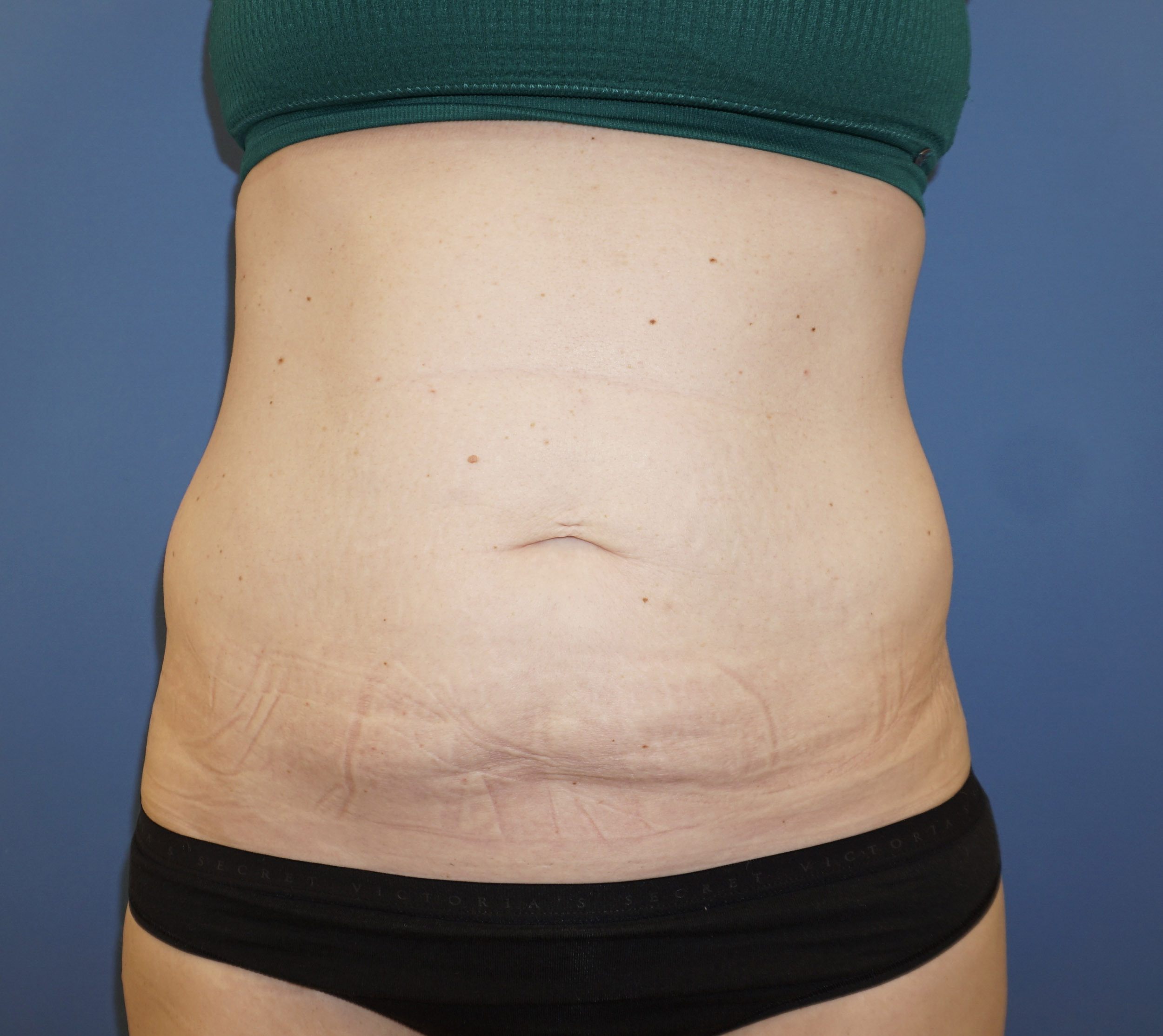 Tummy Tuck – Patient 6 Before