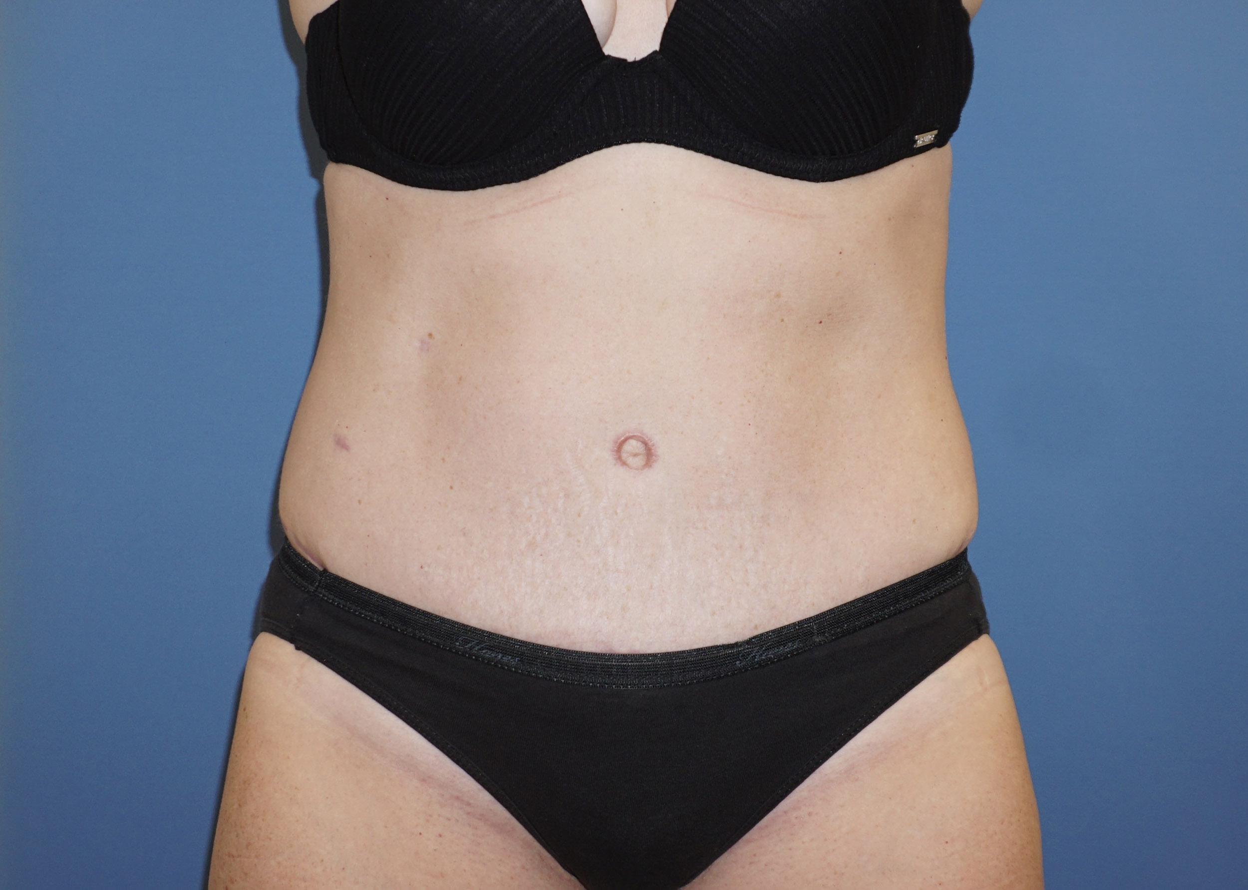Tummy Tuck – Patient 7 After