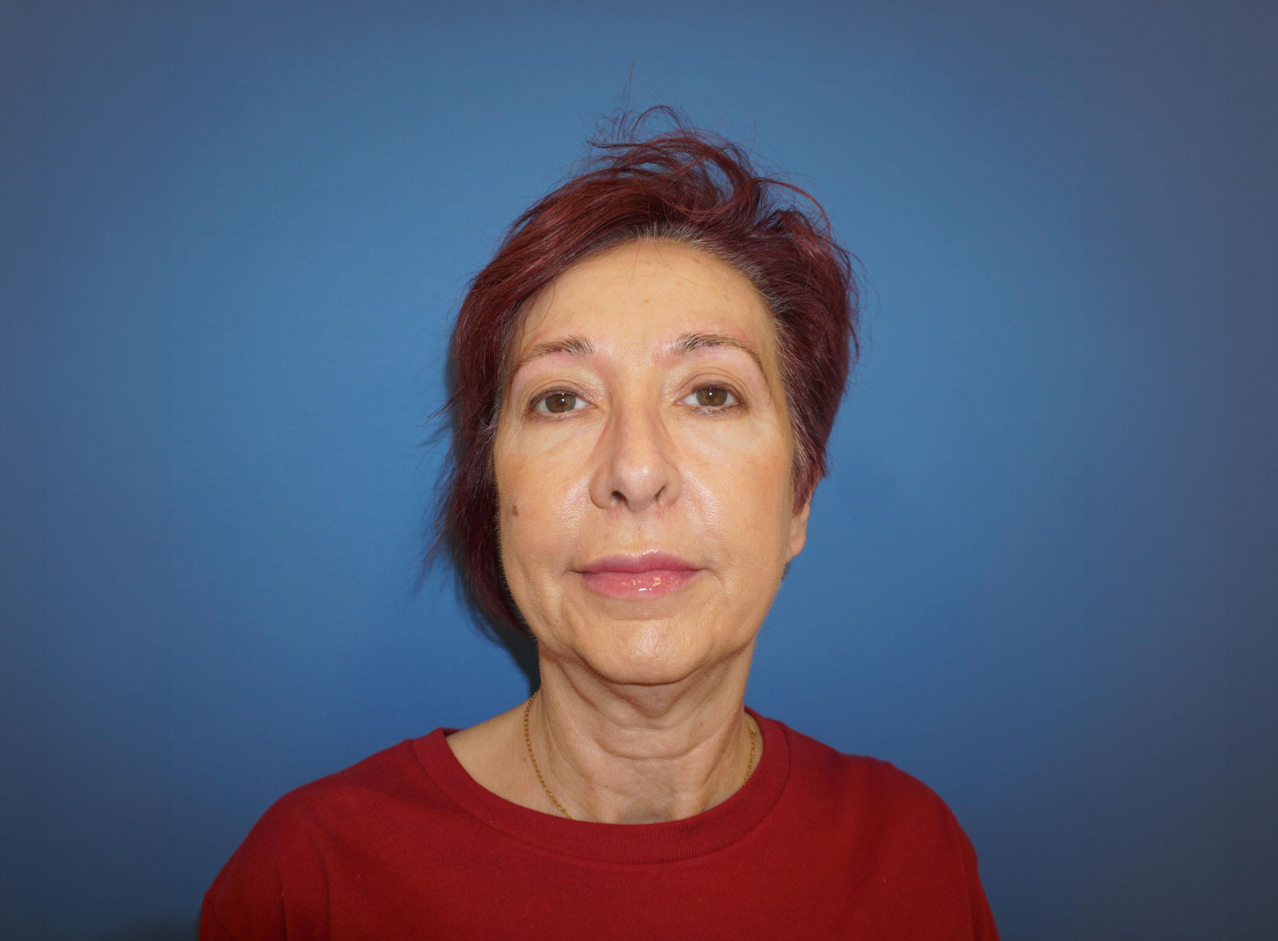 Botox – Patient 7 After