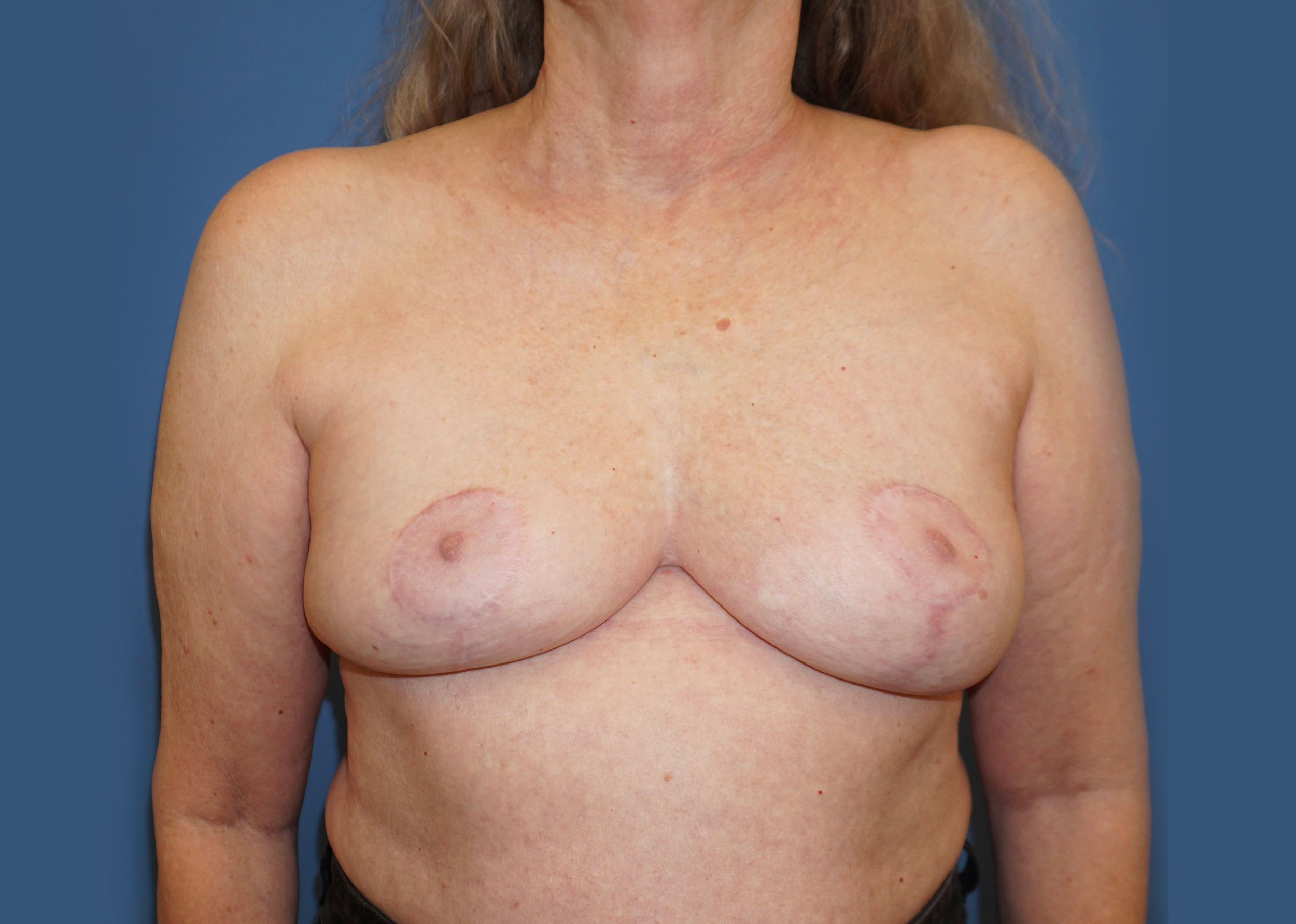 Breast Implant Removal – Patient 7 After