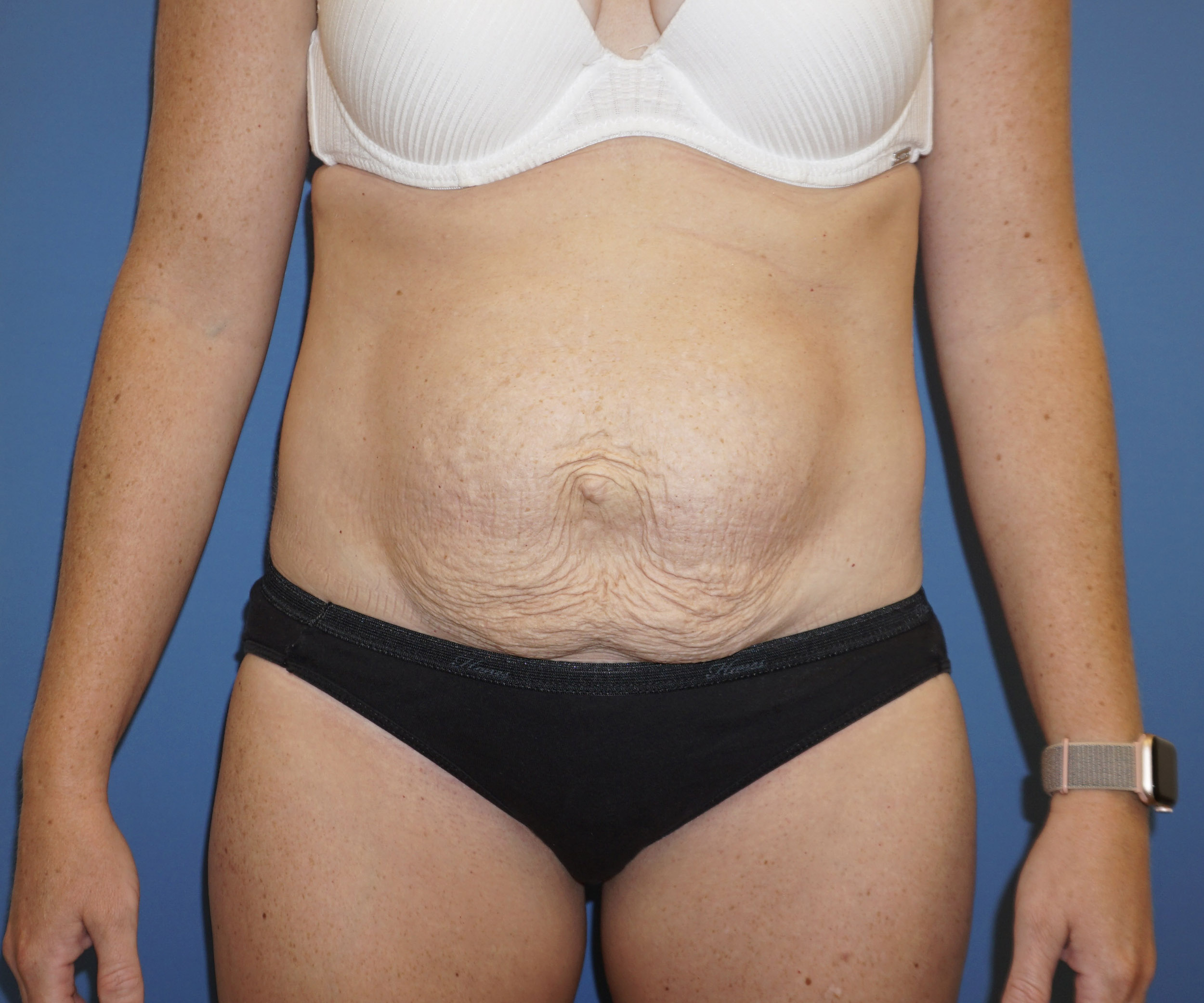 Tummy Tuck – Patient 7 Before