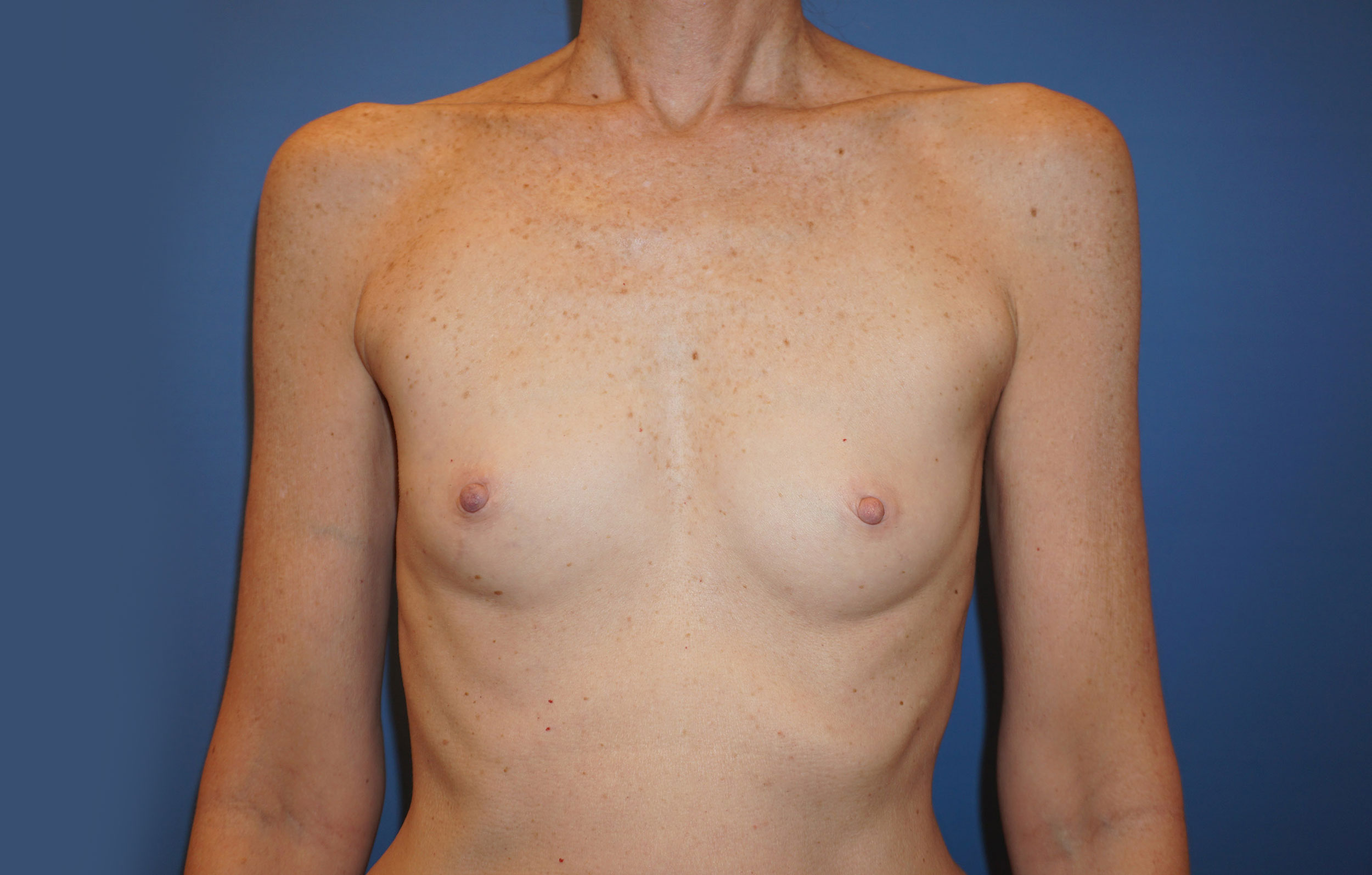 Breast Augmentation – Patient 7 Before