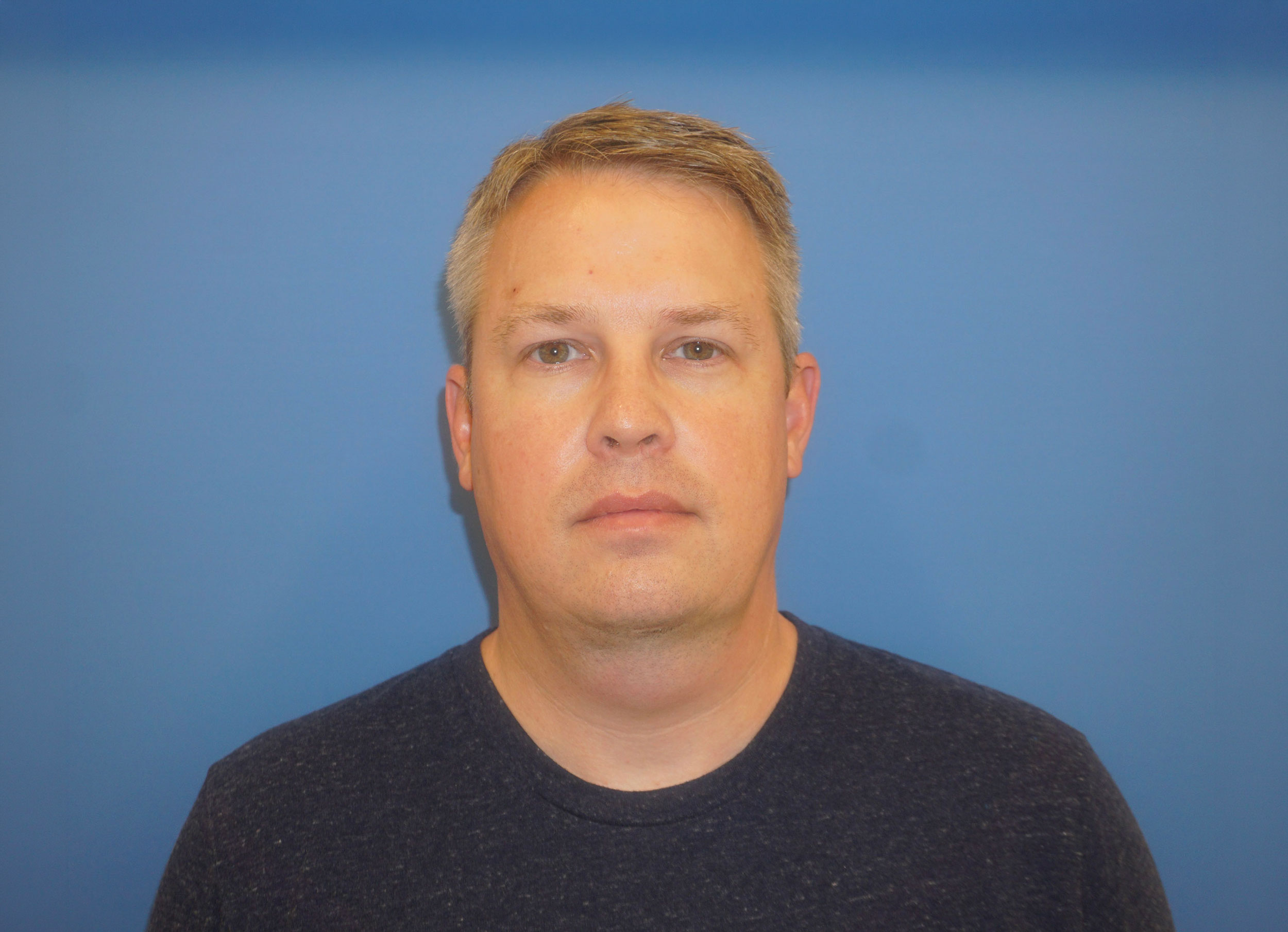 Liposuction – Patient 7 After