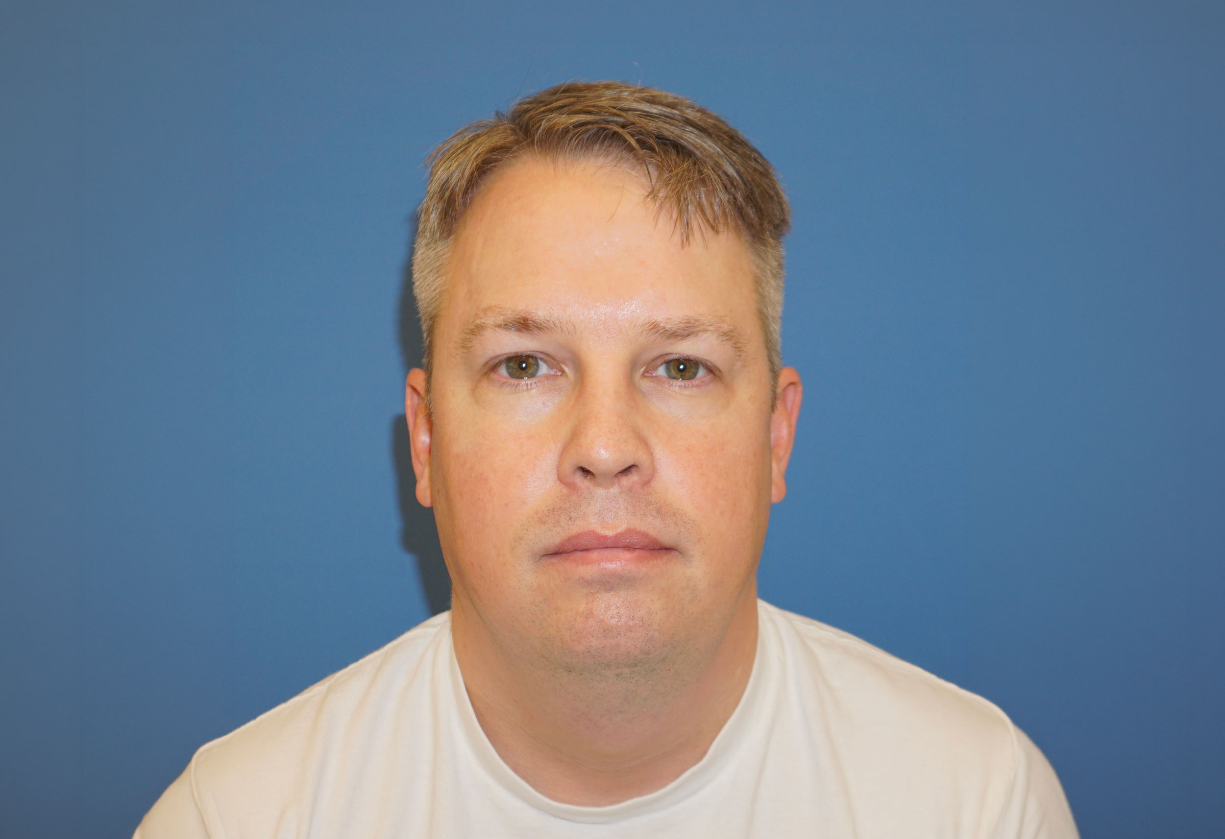 Liposuction – Patient 7 Before