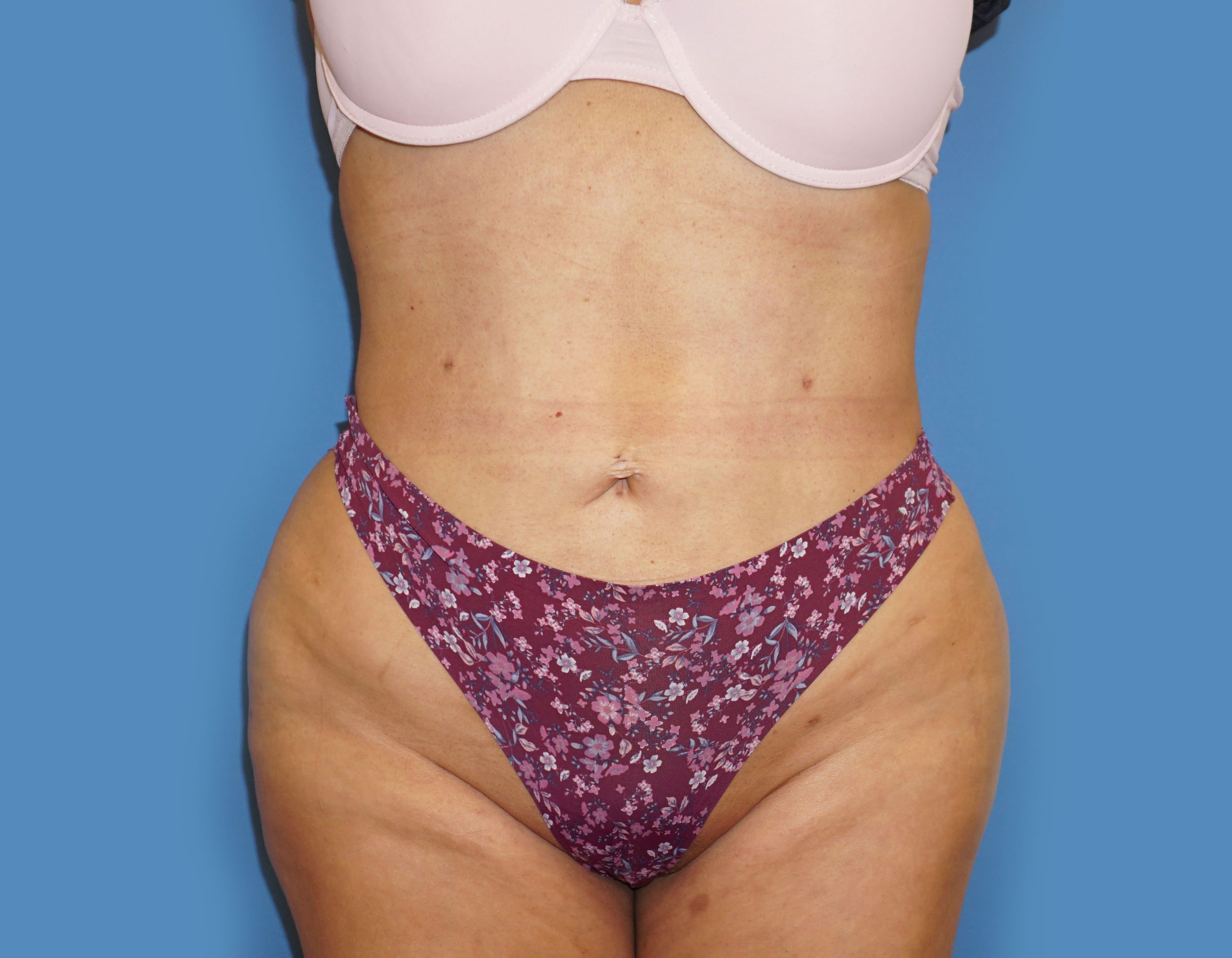Liposuction – Patient 8 After