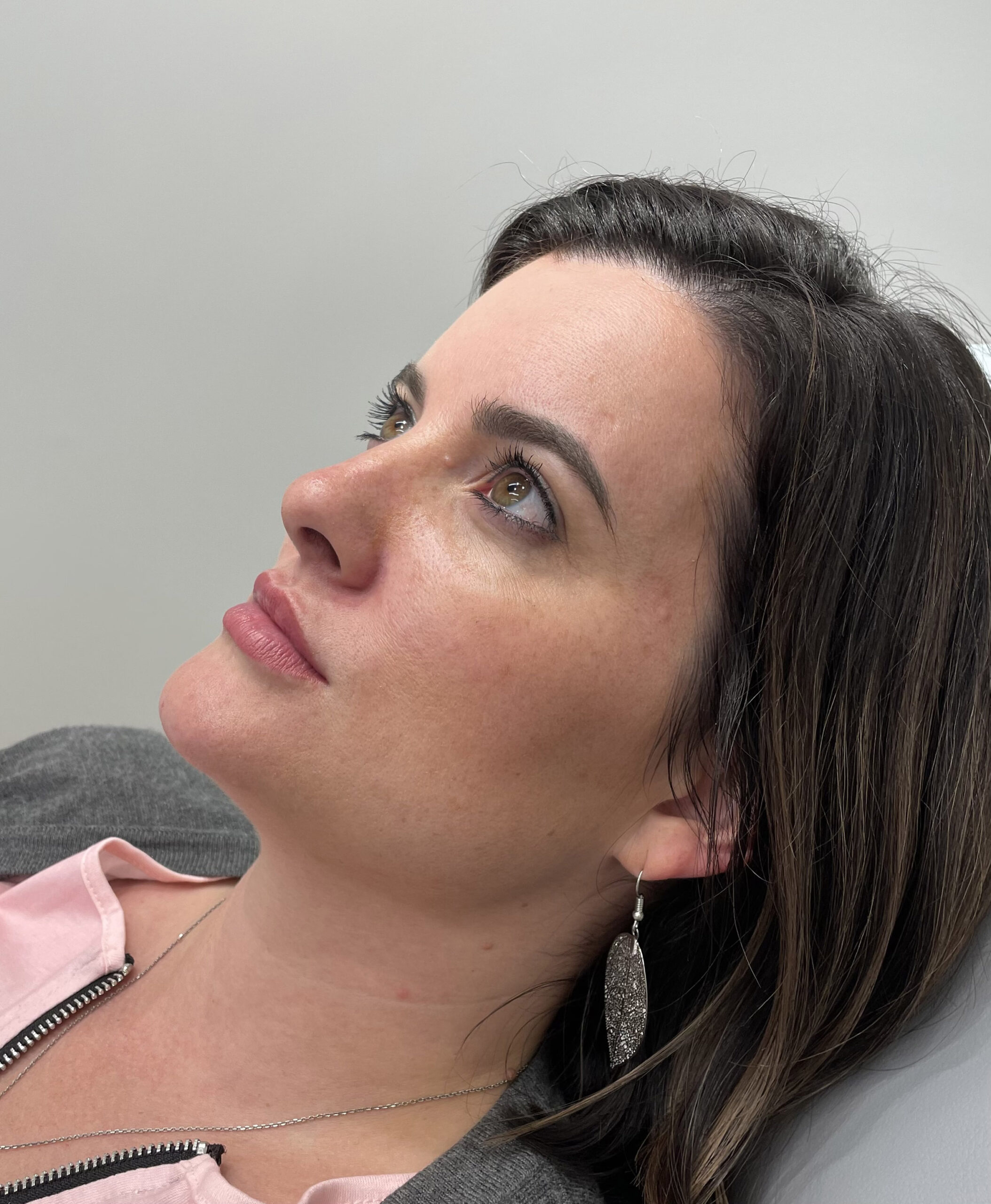 Botox – Patient 8 Before