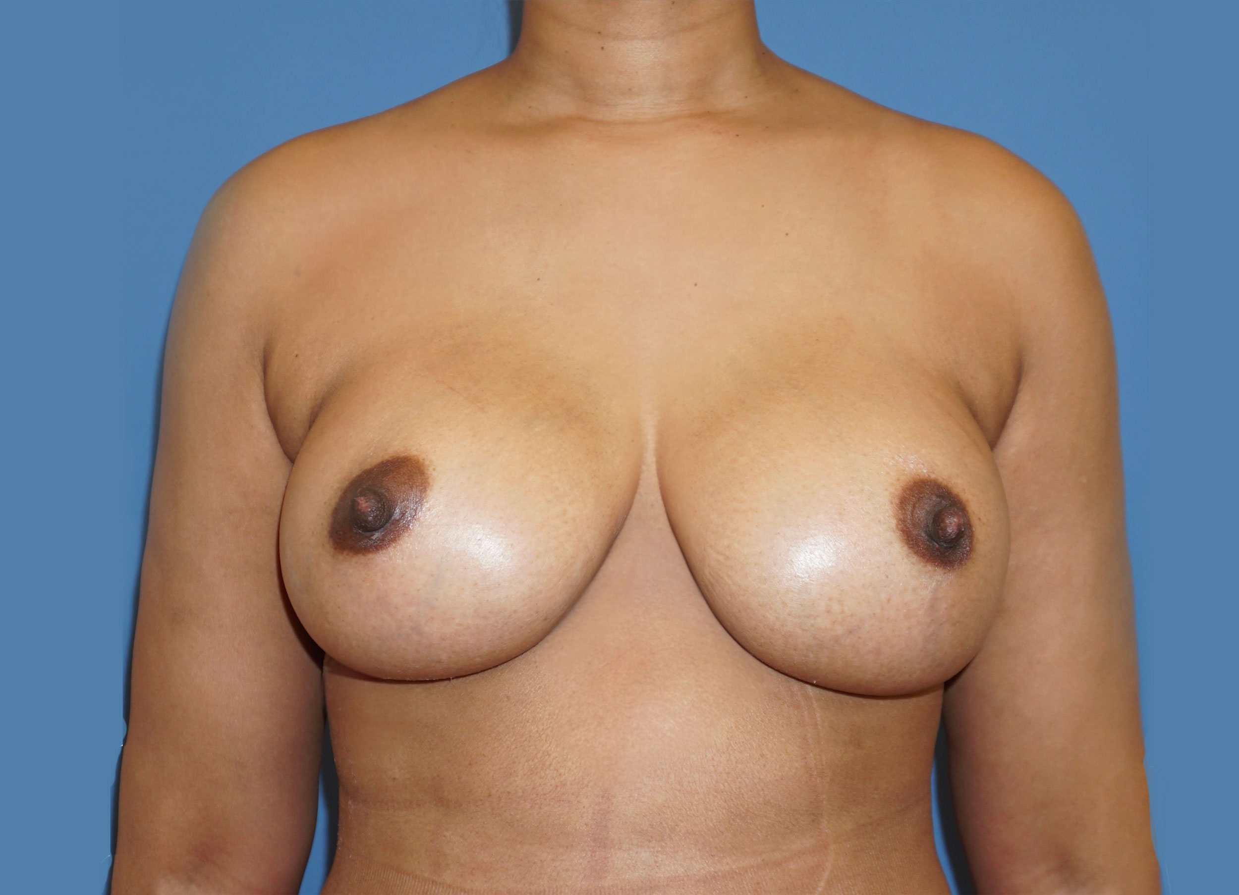 Breast Augmentation – Patient 9 After