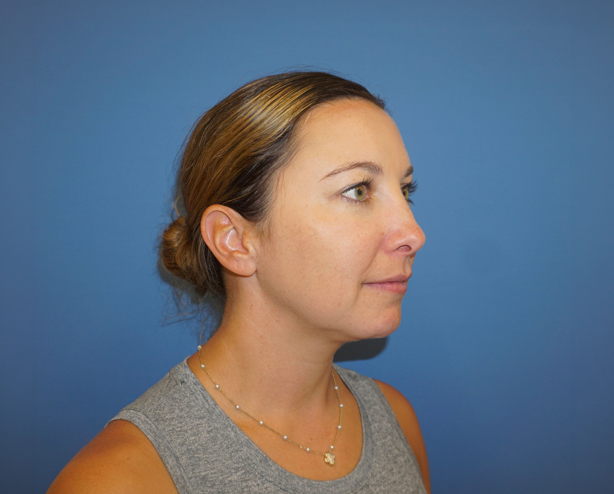 Liposuction – Patient 9 After