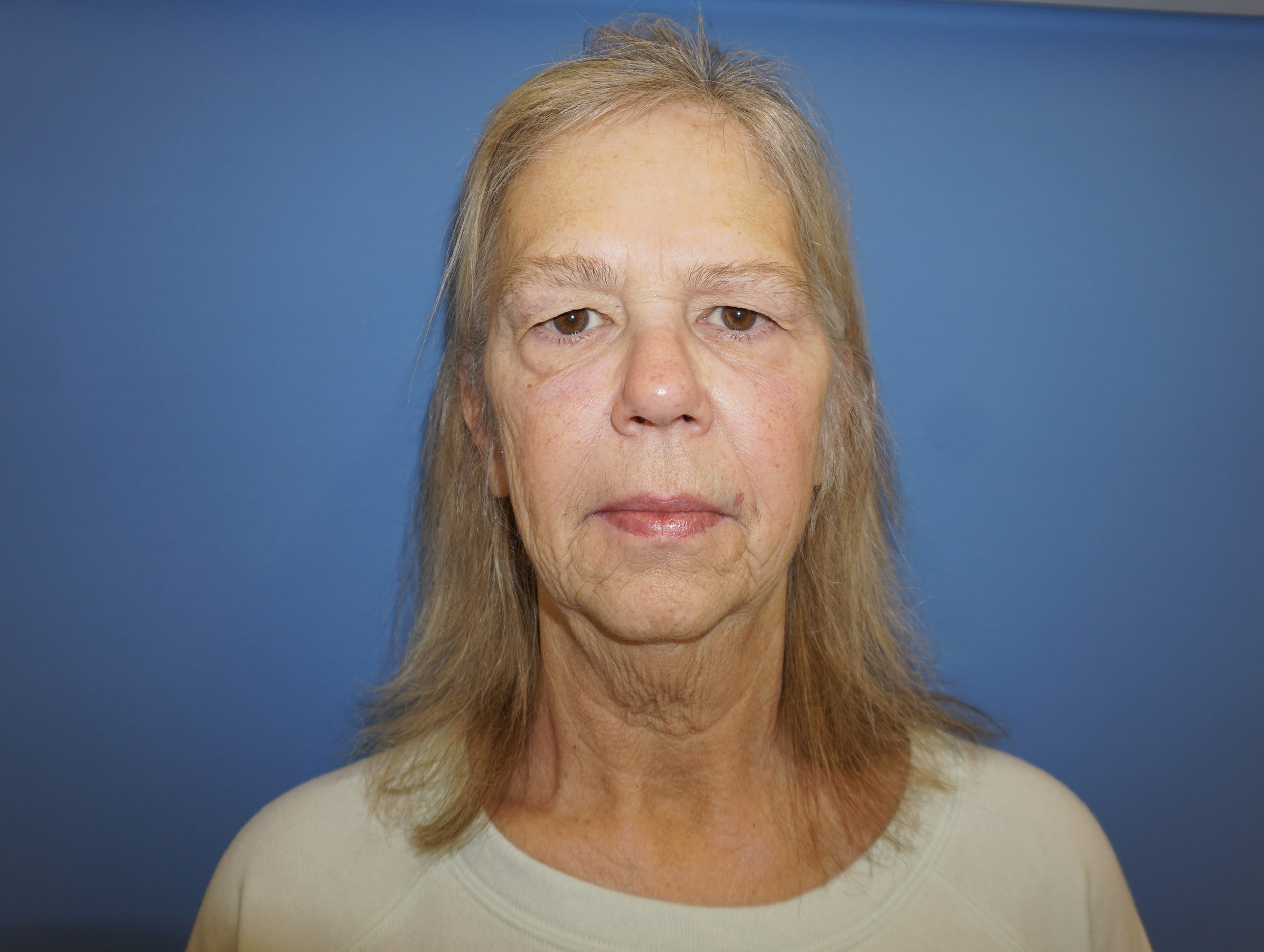 Blepharoplasty – Patient 9 Before