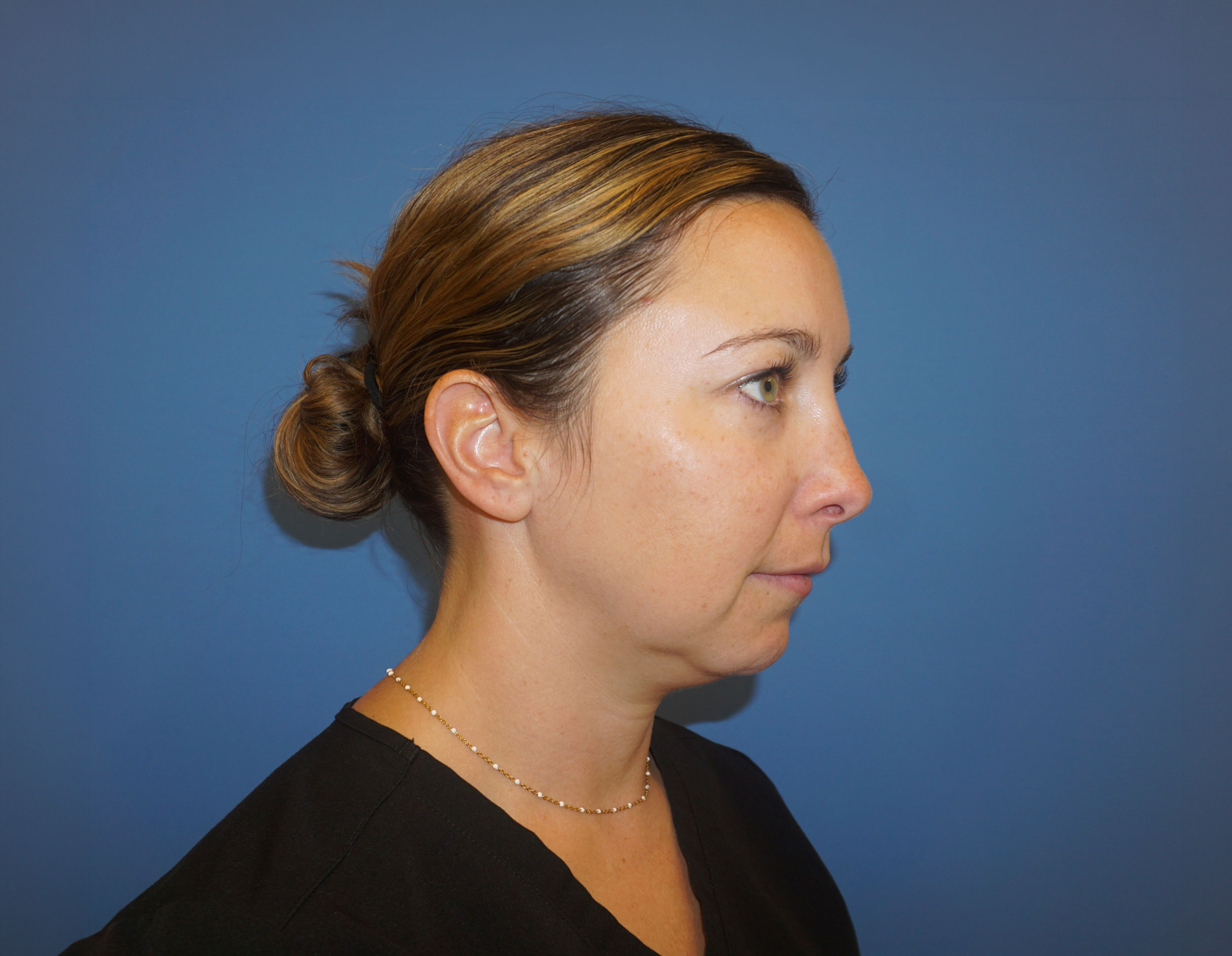Liposuction – Patient 9 Before