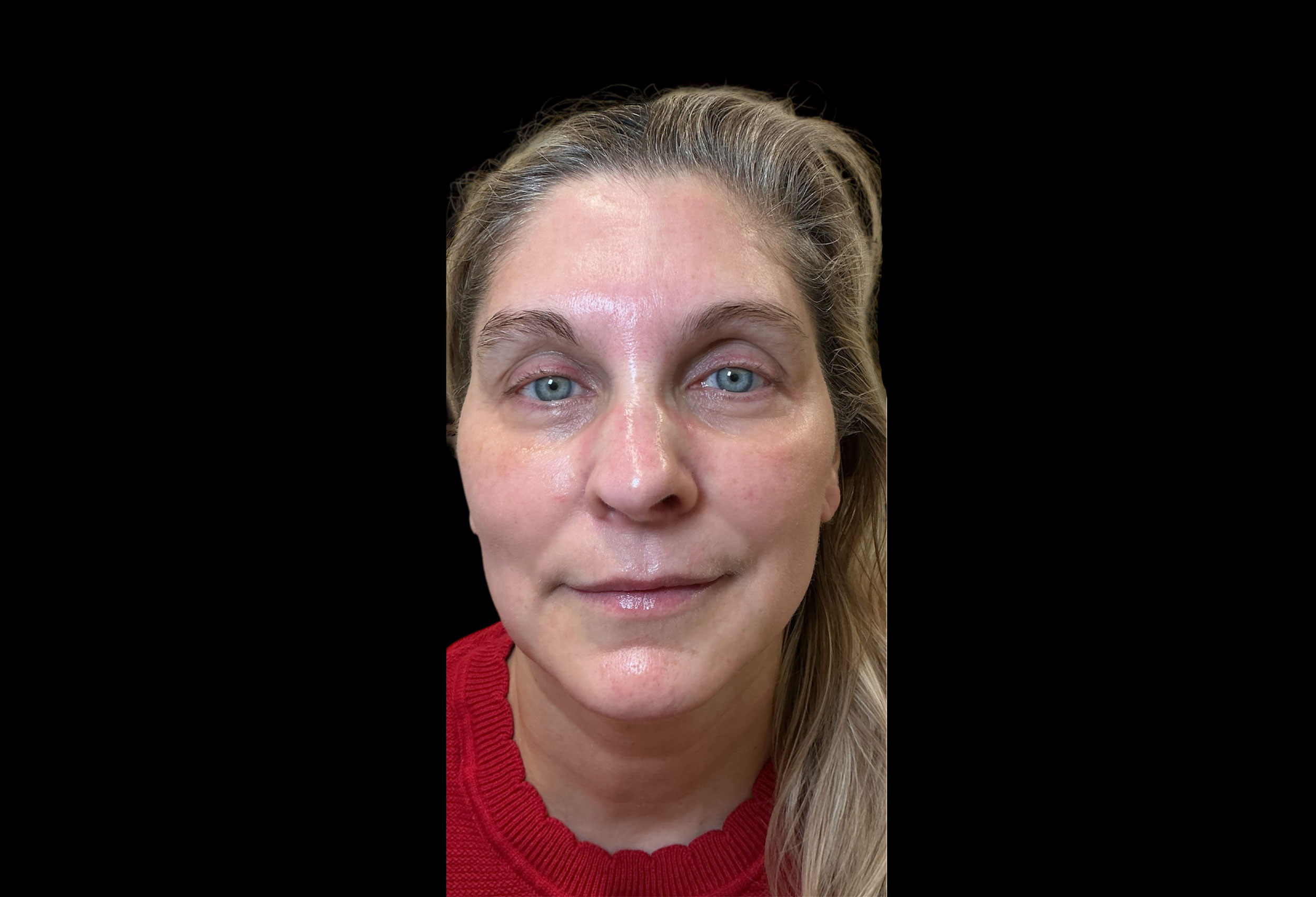 Laser Treatment – Patient 1 After