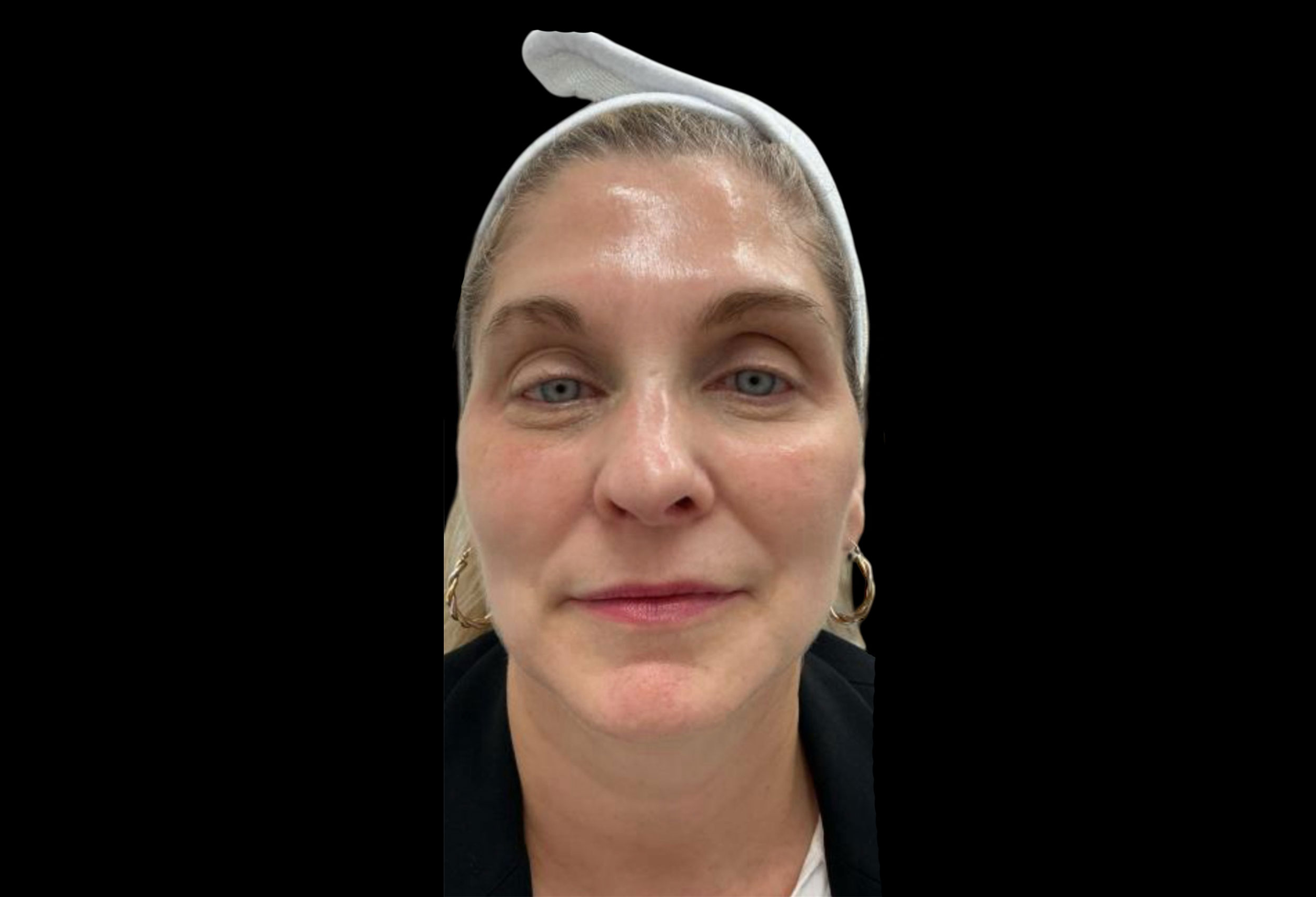 Laser Treatment – Patient 1 Before