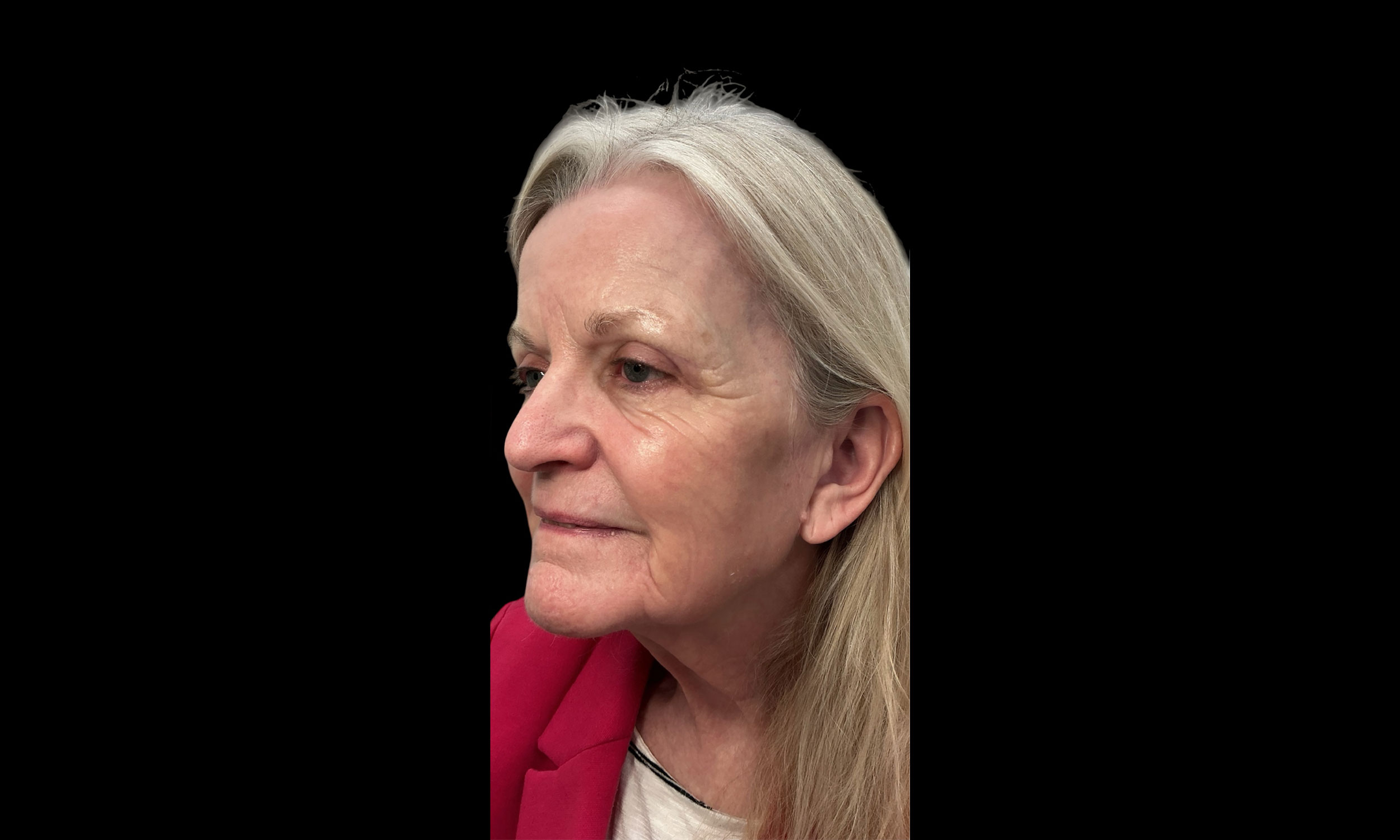 Laser Treatment – Patient 2 After