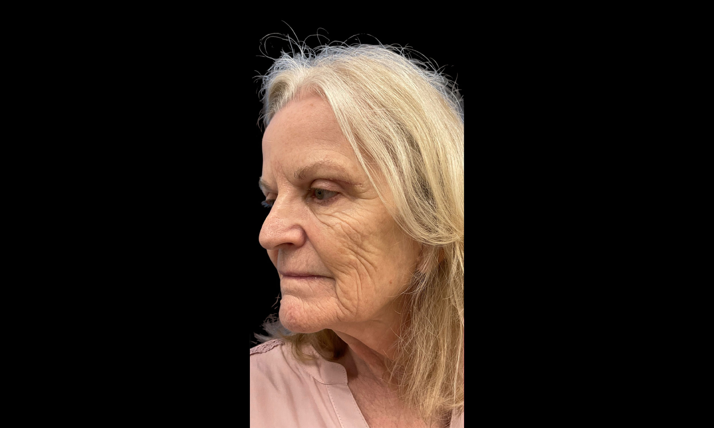 Laser Treatment – Patient 2 Before