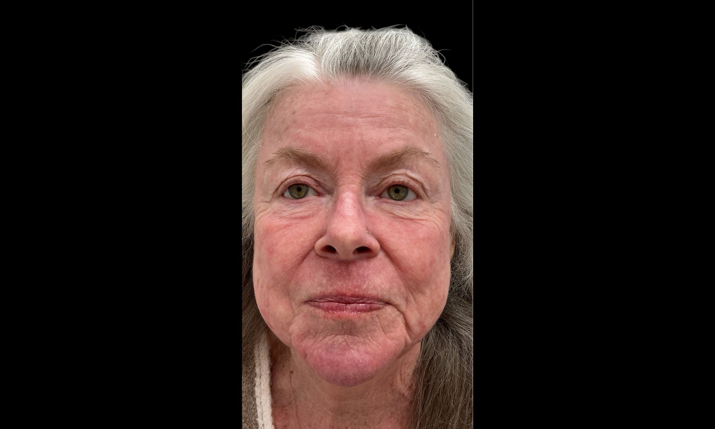 Laser Treatment – Patient3 After