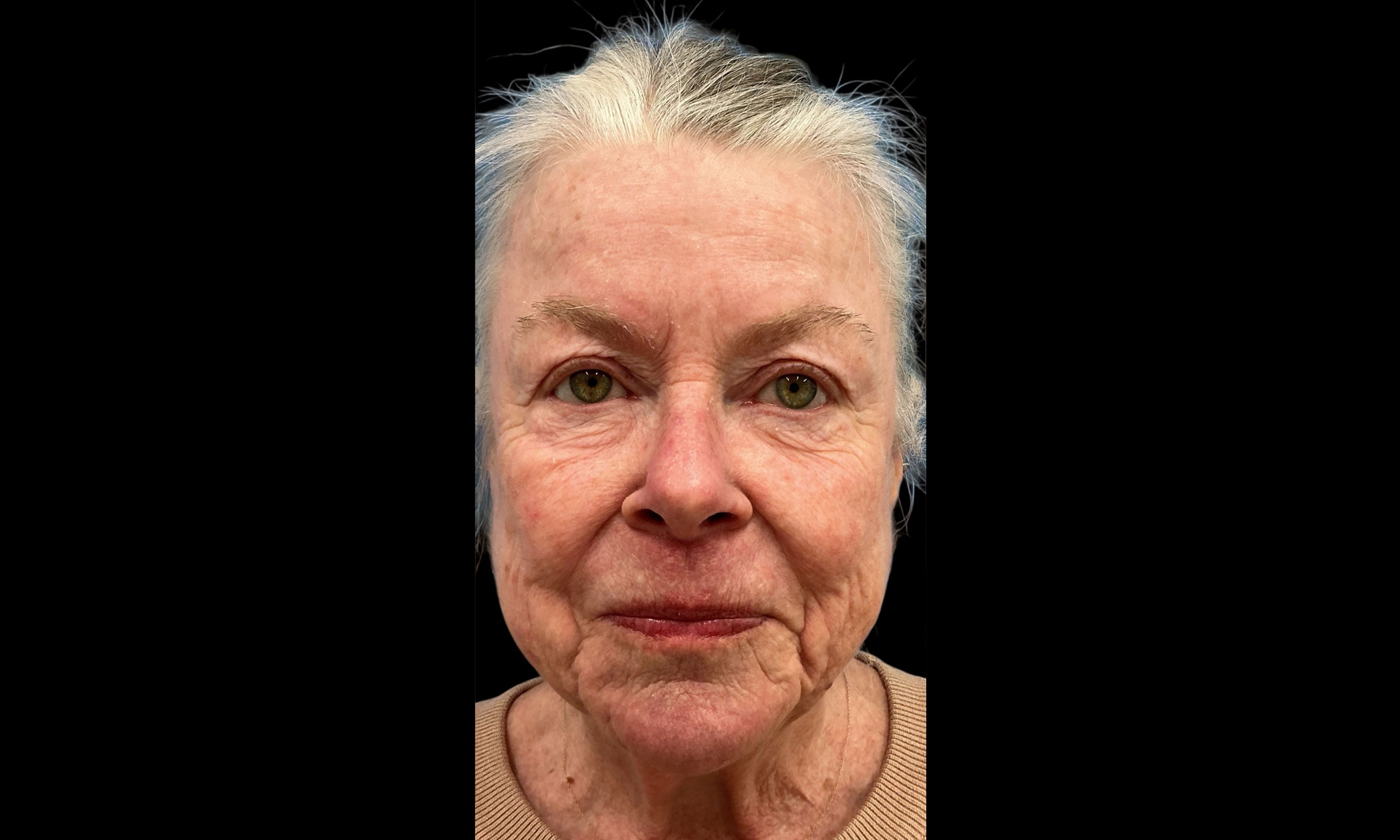 Laser Treatment – Patient 3 Before