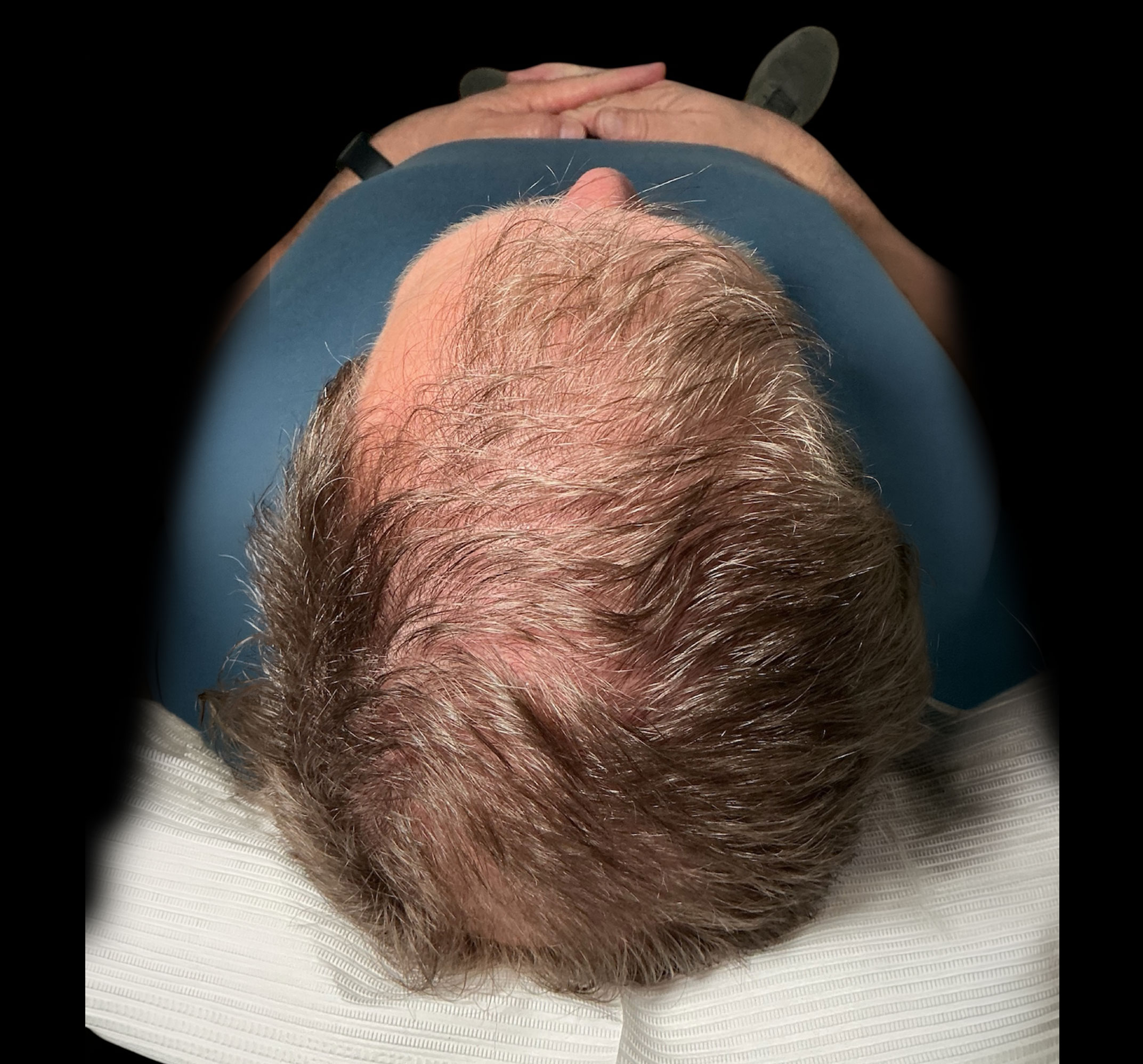 Hair Growth – Patient 2 After