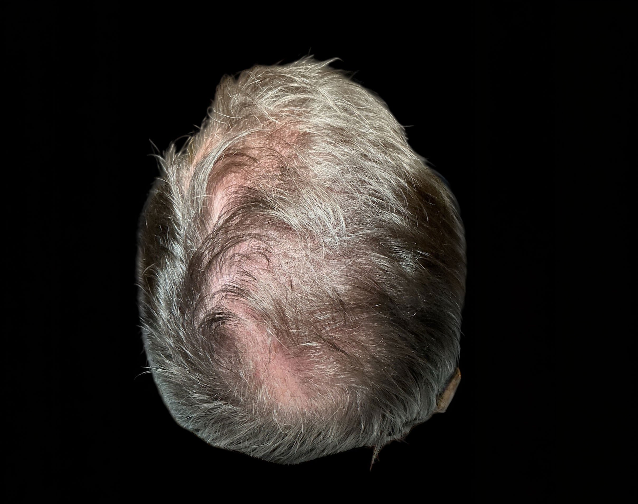 Hair Growth – Patient 2 Before