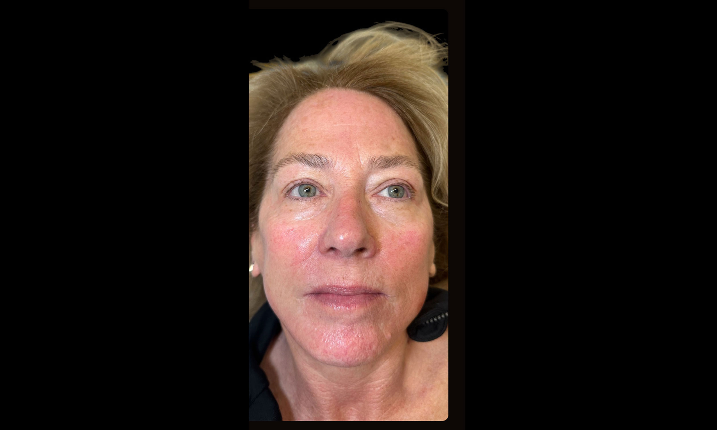 Laser Treatment – Patient 4 After