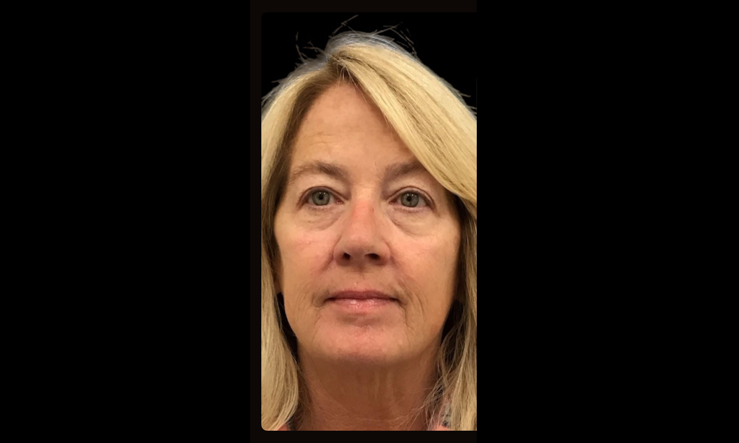 Laser Treatment – Patient 4 Before
