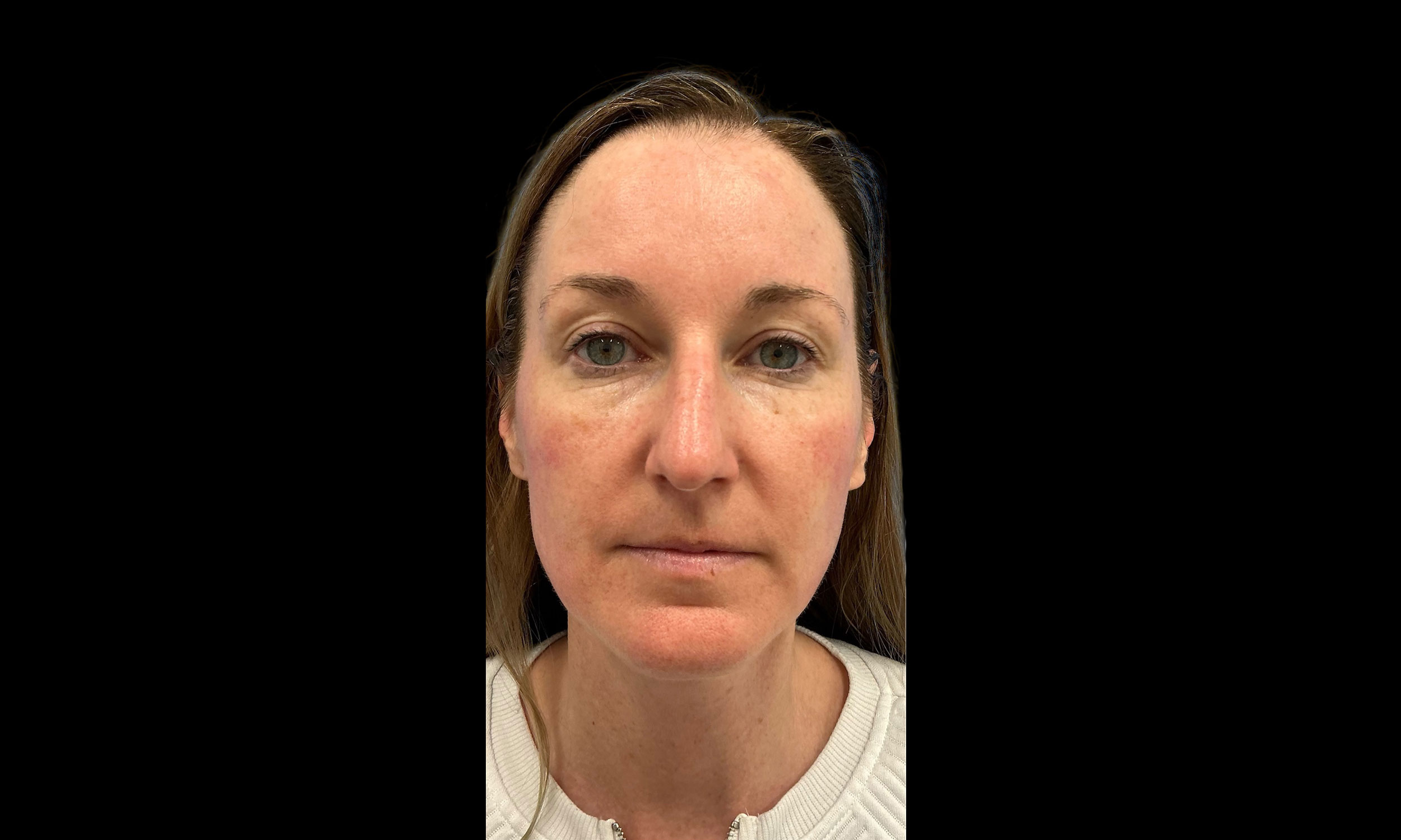 Laser Treatment – Patient 5 After