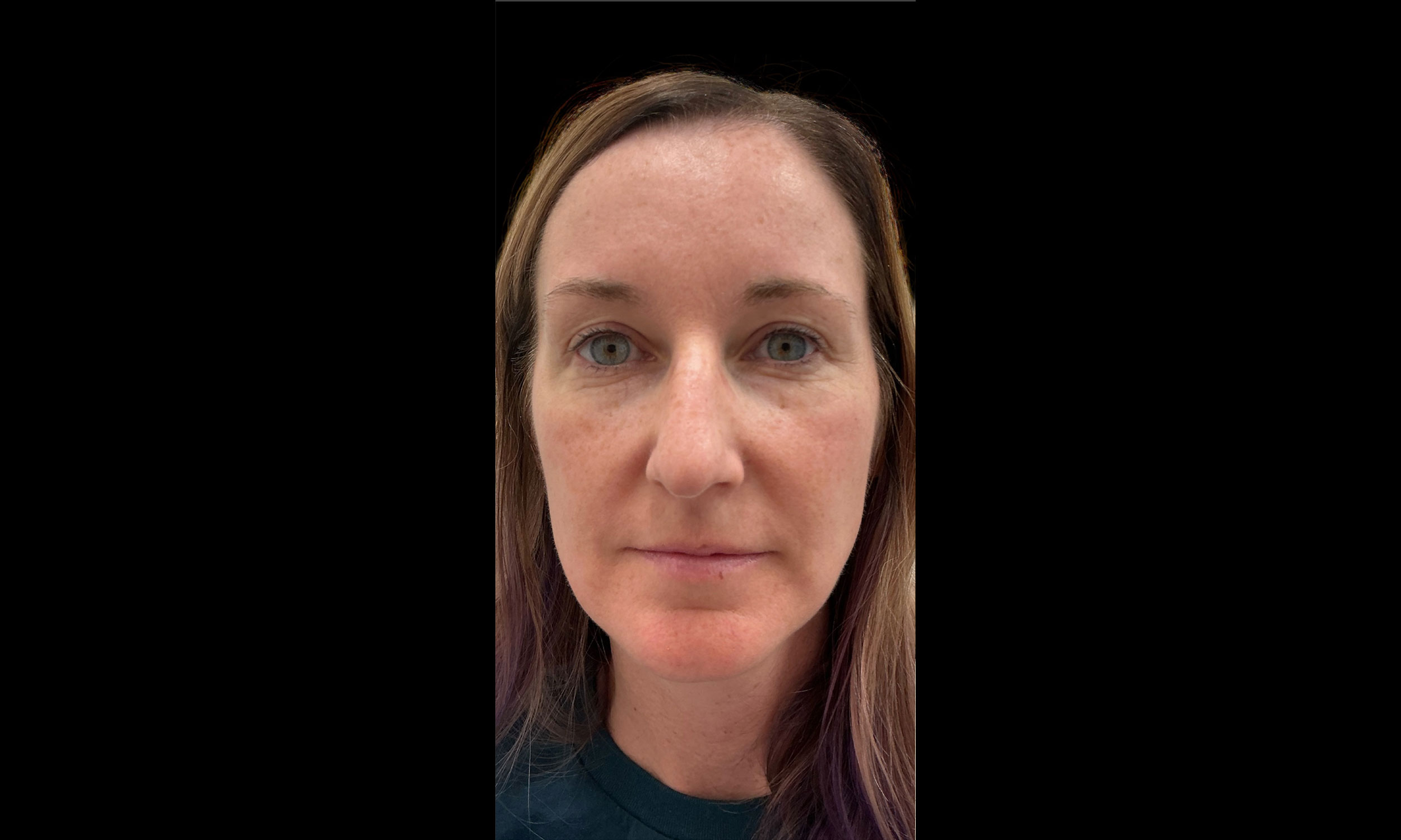 Laser Treatment – Patient 5 Before