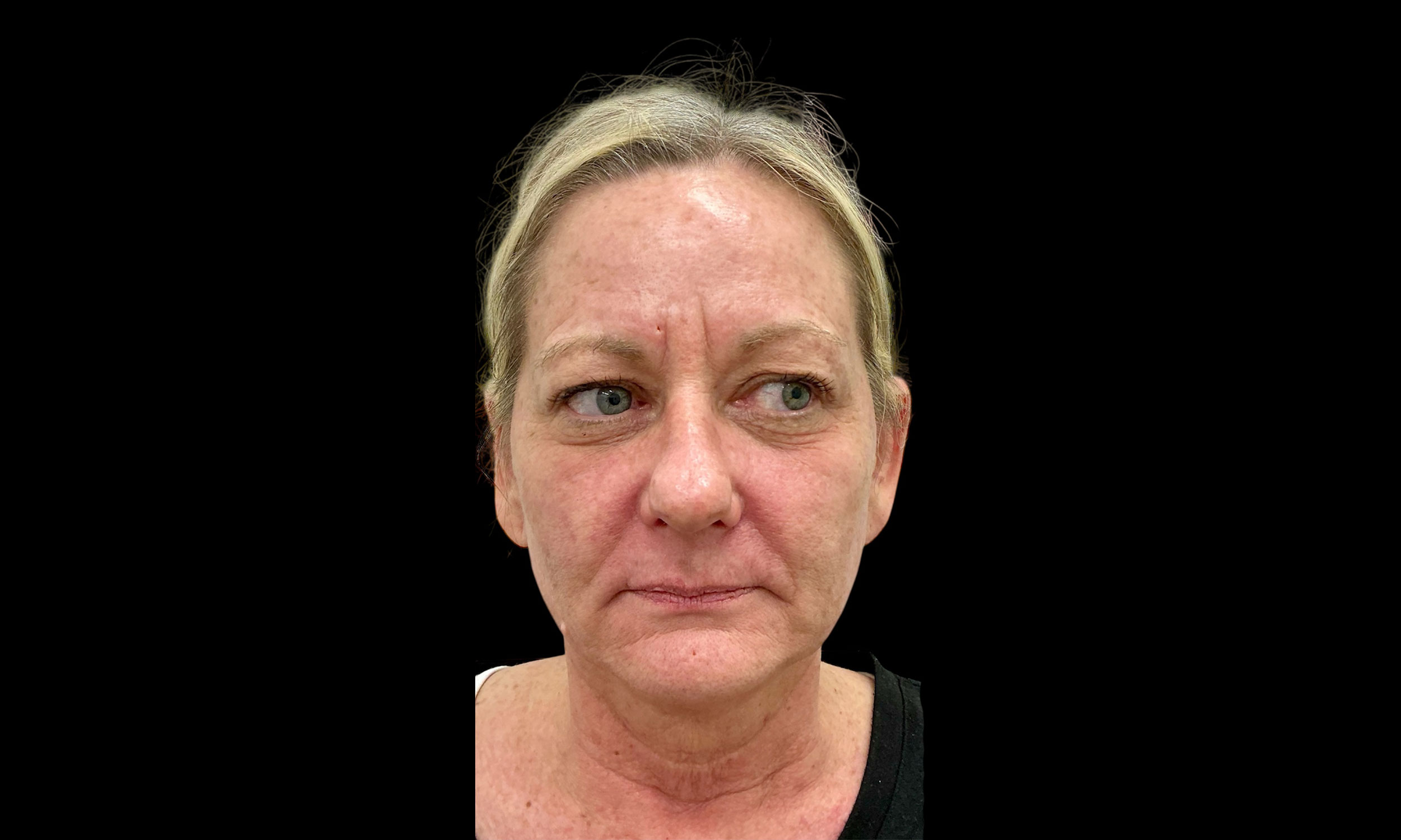 Laser Treatment – Patient 6 After