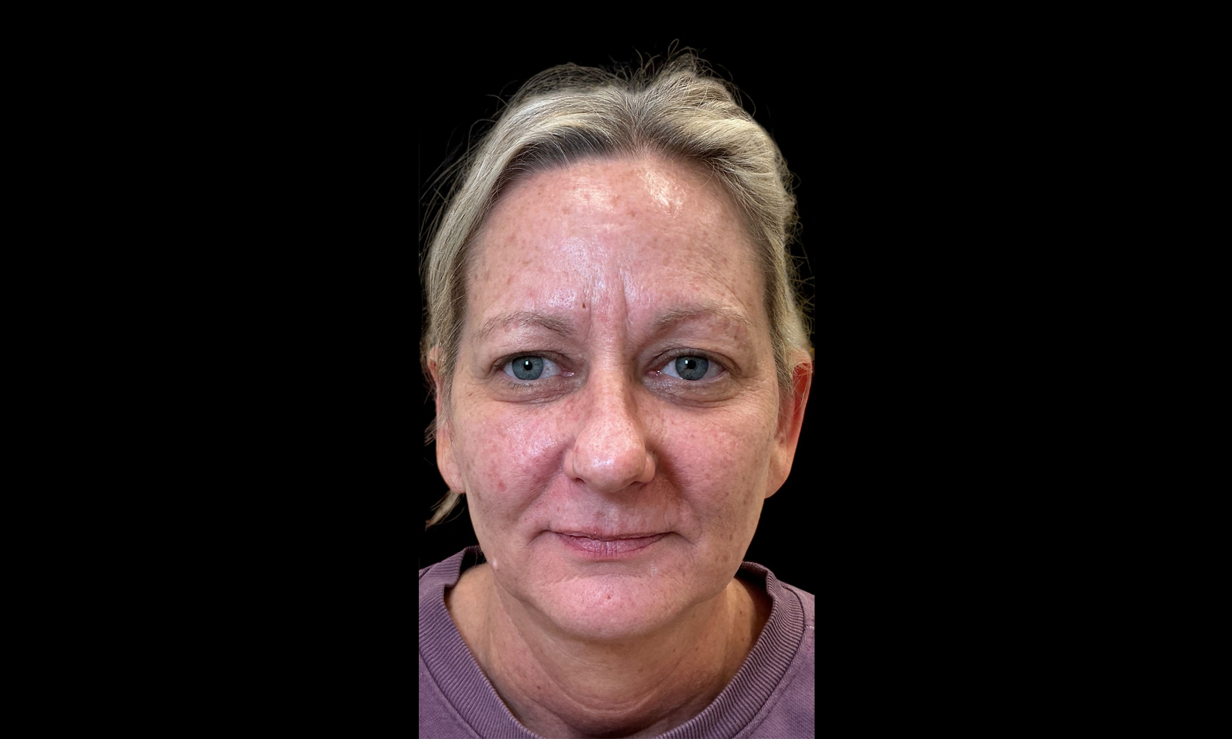 Laser Treatment – Patient Before