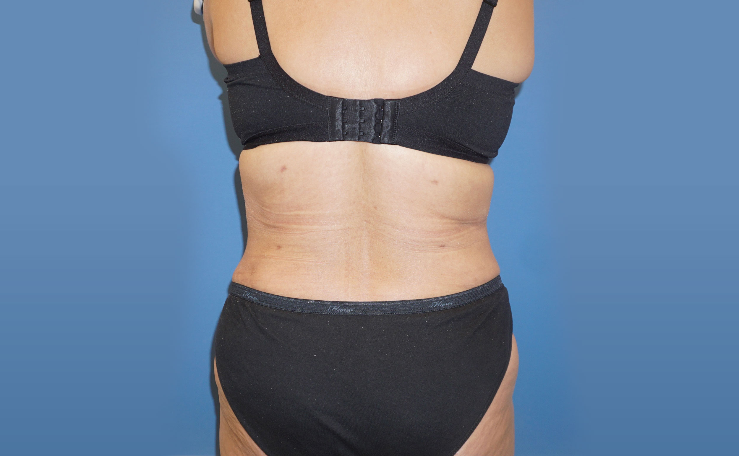 Liposuction – Patient 11 After