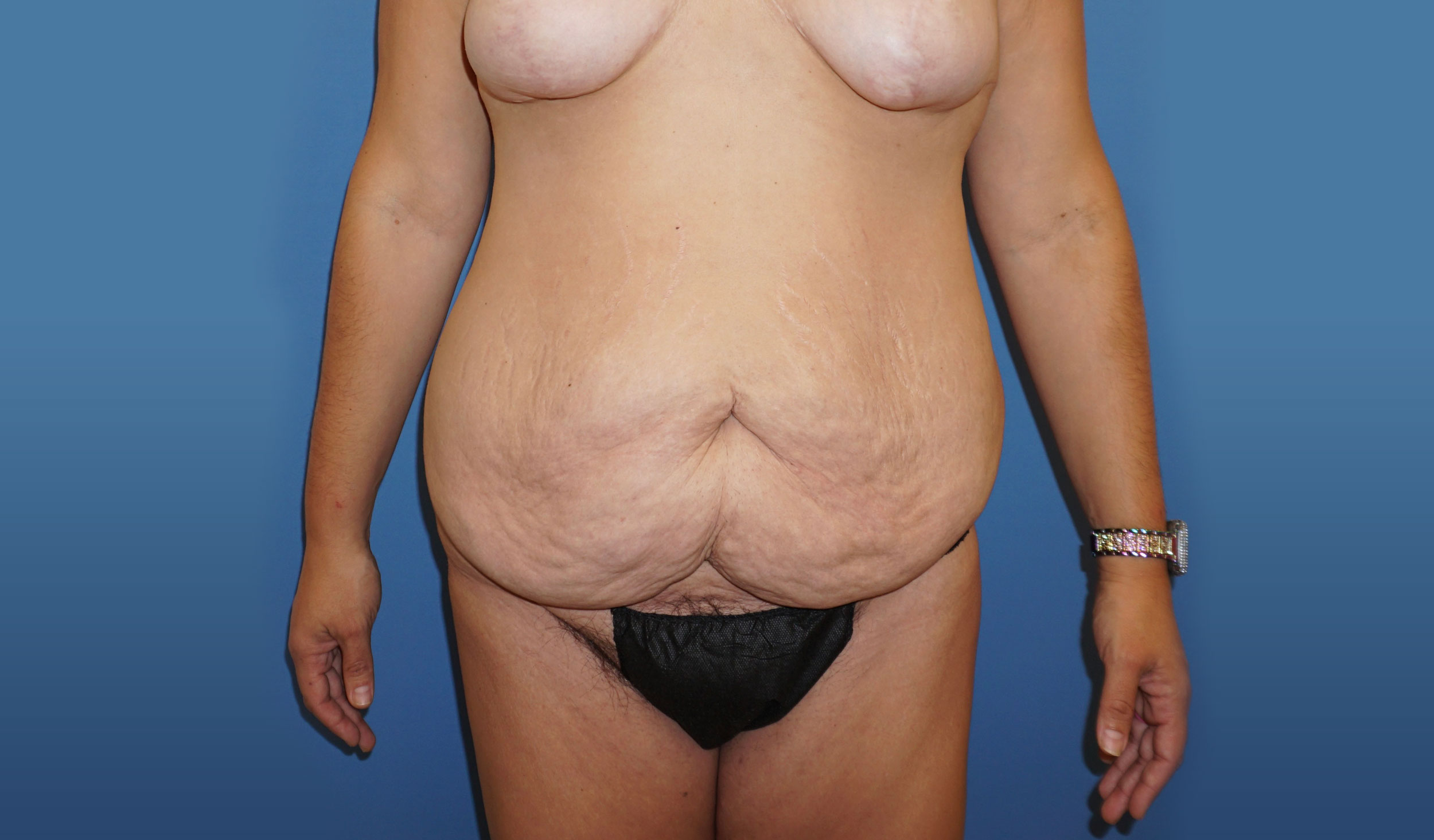 Tummy Tuck – Patient 11 Before